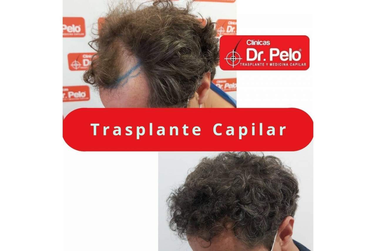 La mejoría en los precios y las técnicas aplicadas provoca el aumento de popularidad del transplante capilar en los últimos años en España