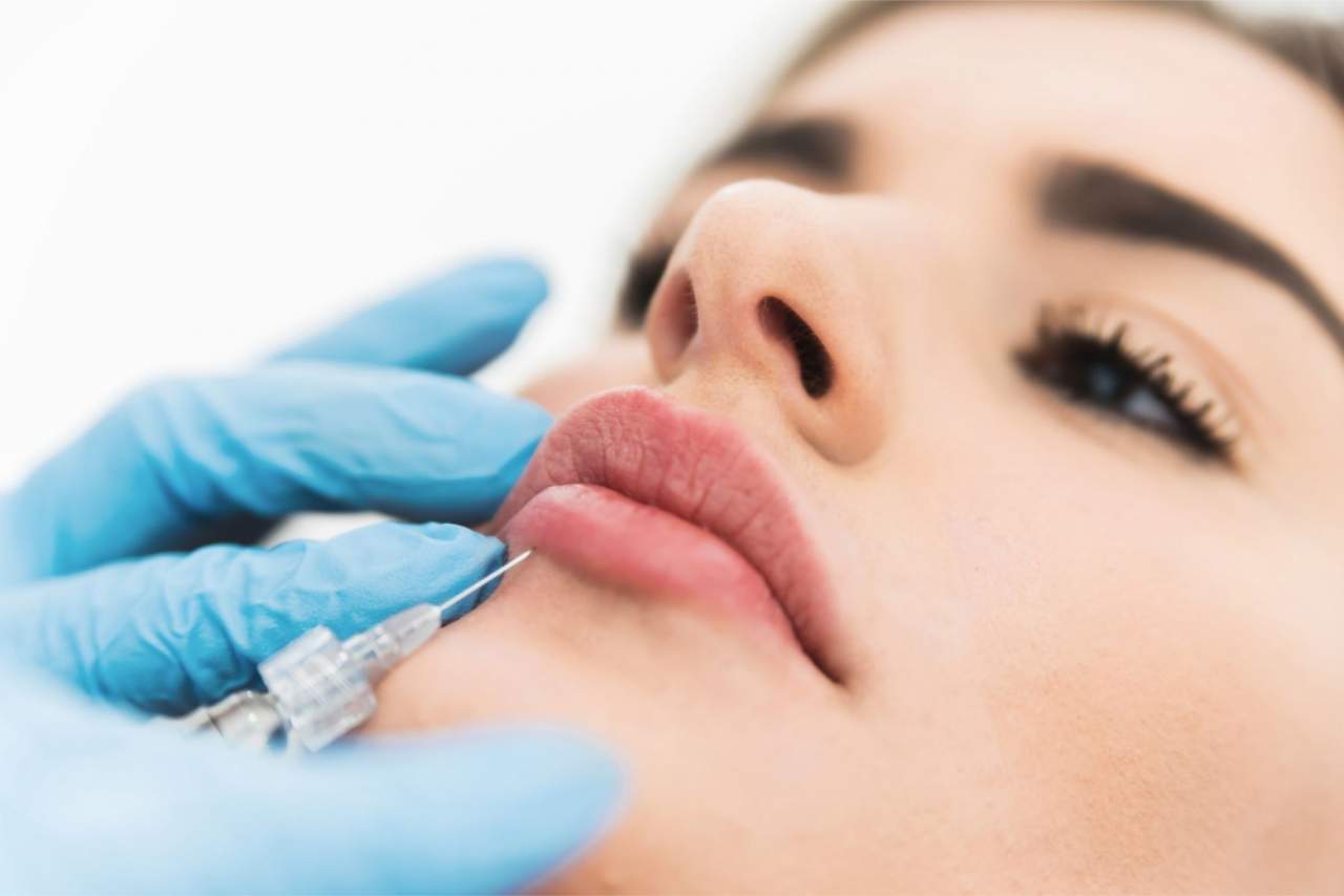 Aumento de labios con ácido hialurónico en la Clínica Dr. Zito