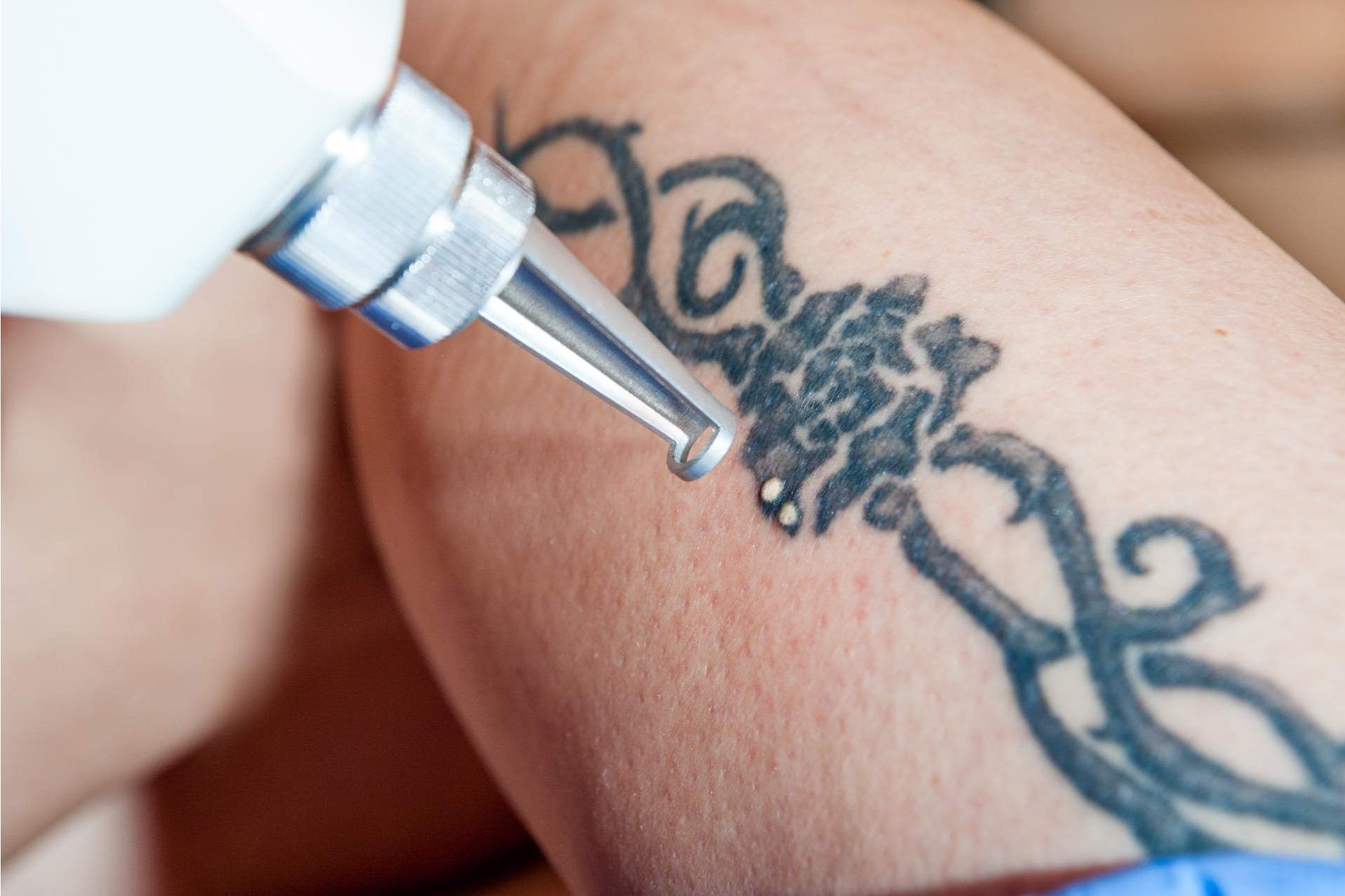 Tecnología láser para eliminar tatuajes  por Bodyslim
