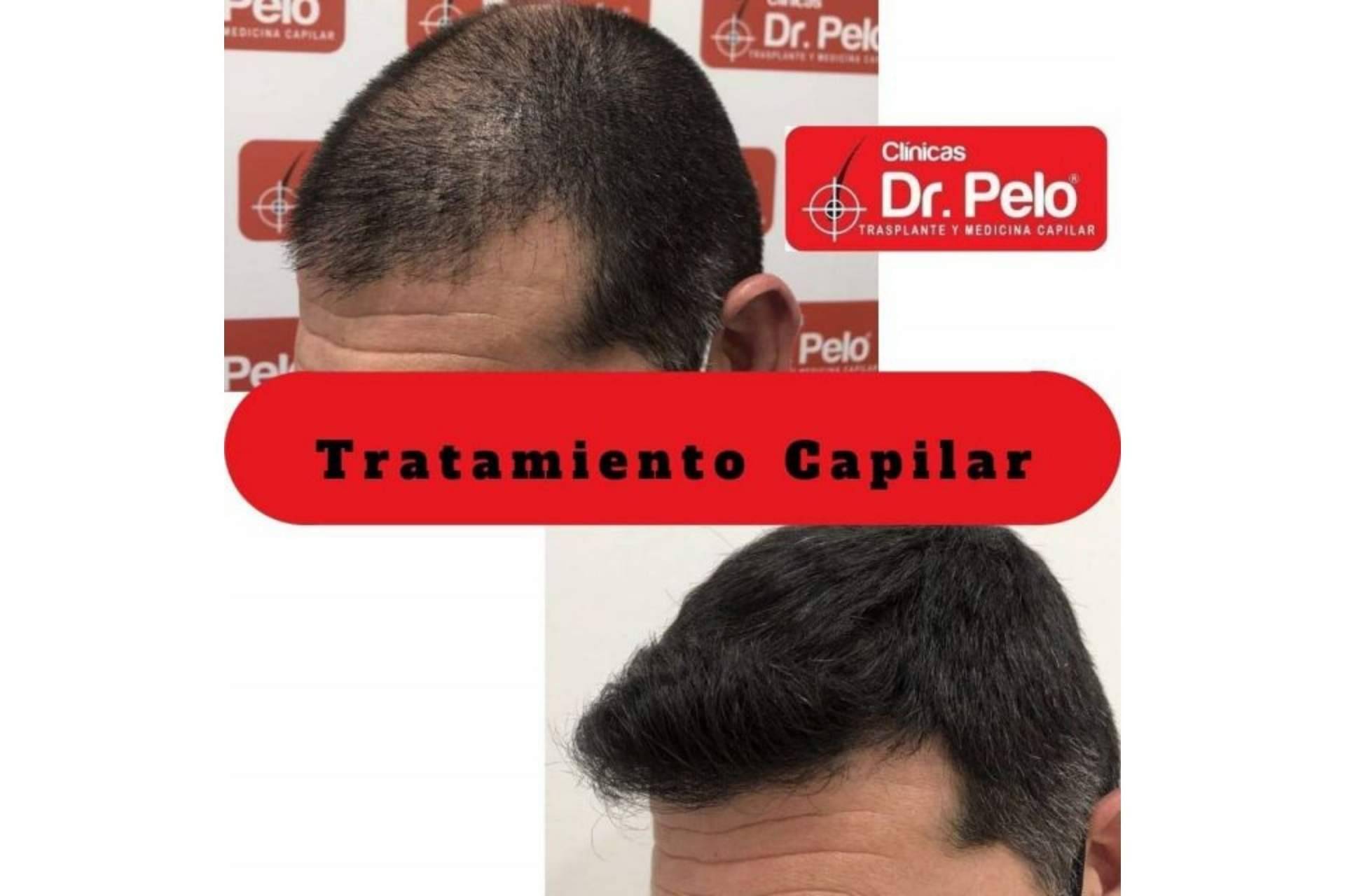 Frenar las entradas en el pelo gracias a los tratamientos y el equipo de profesionales de las Clínicas Dr. Pelo