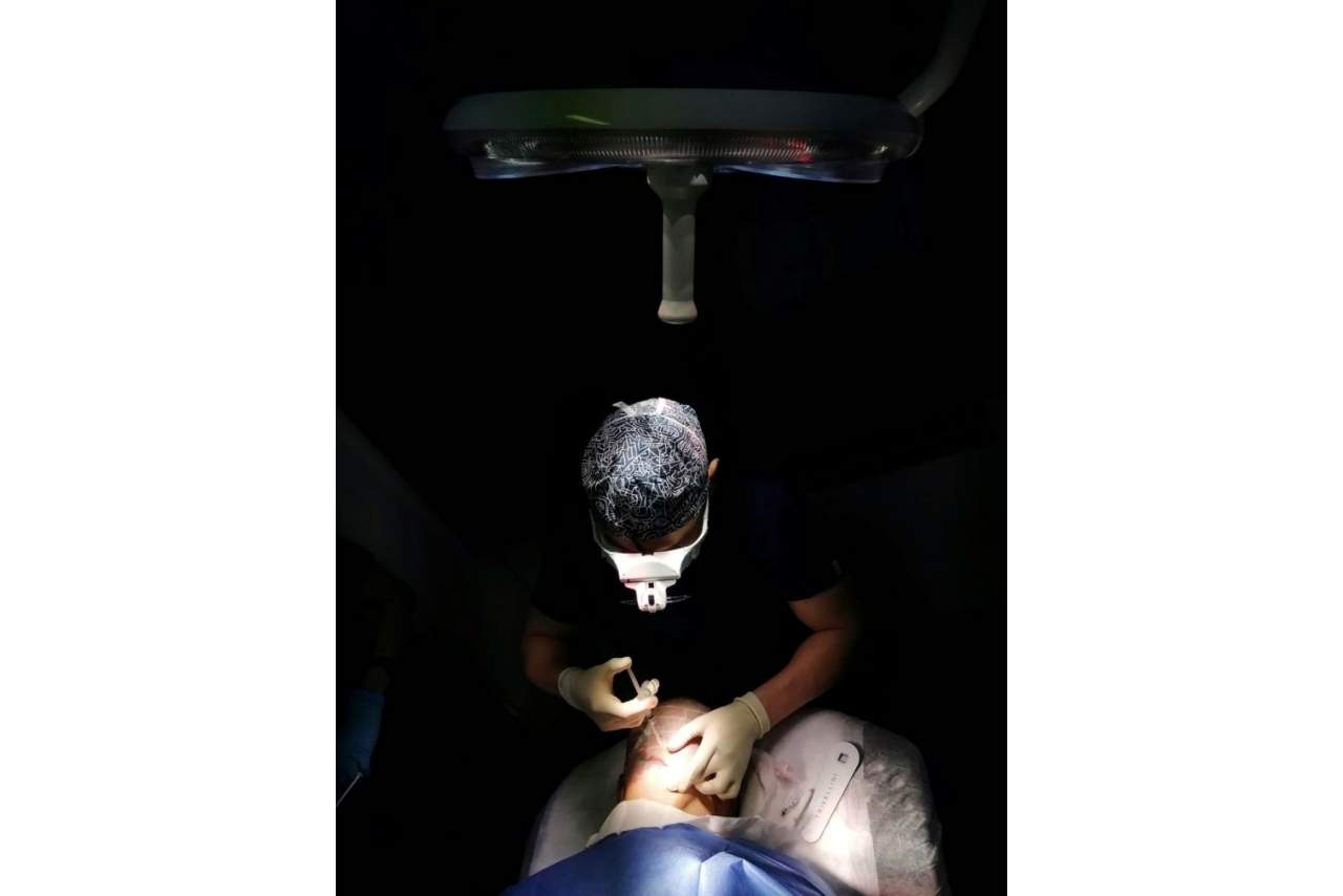 Injerto capilar no invasivo mediante el método DHI de la mano del Doctor Franz Joseph Bern Barbehito