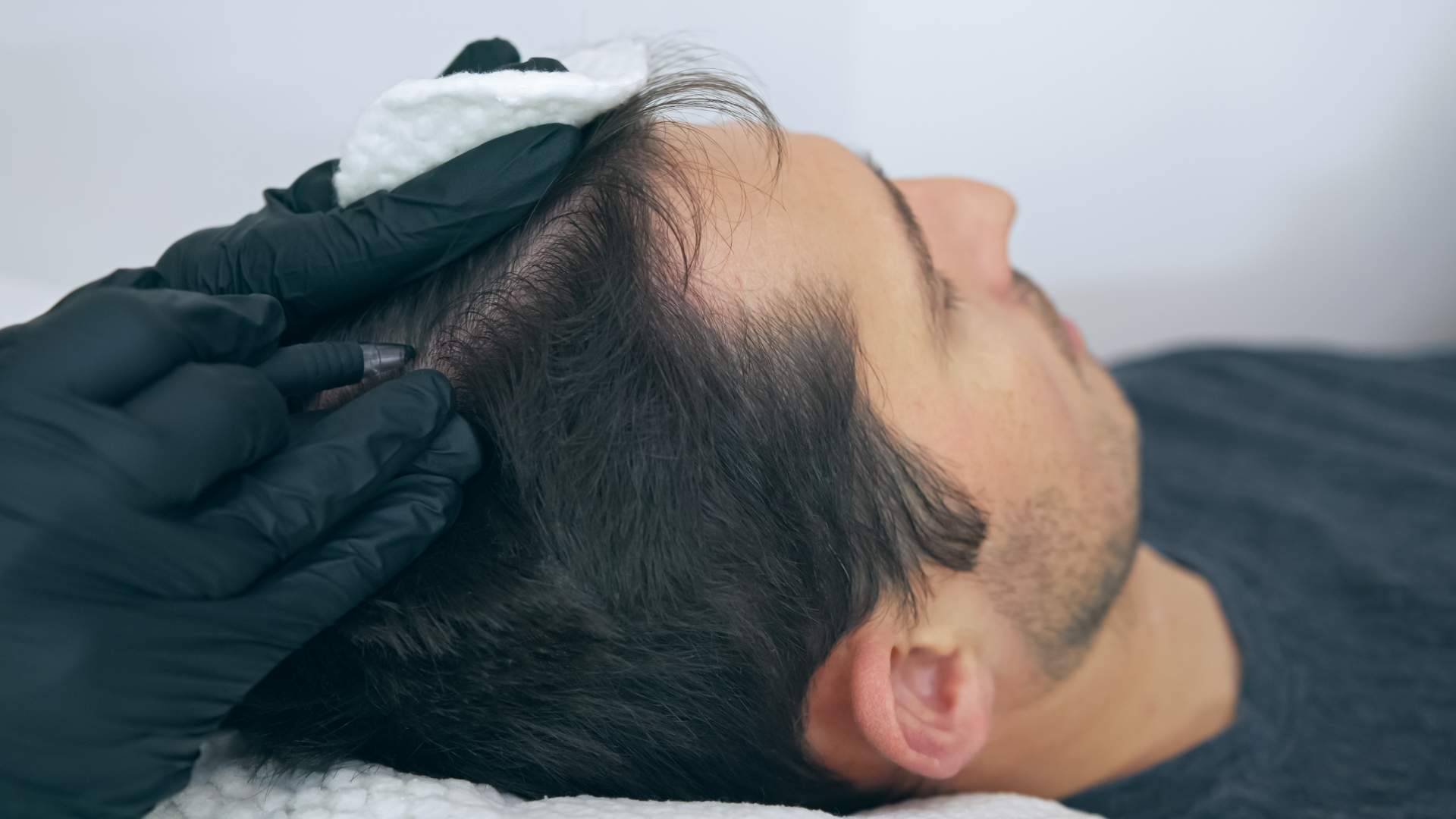 El centro Distrito Wellness Concept ofrece entre sus servicios la micropigmentación capilar