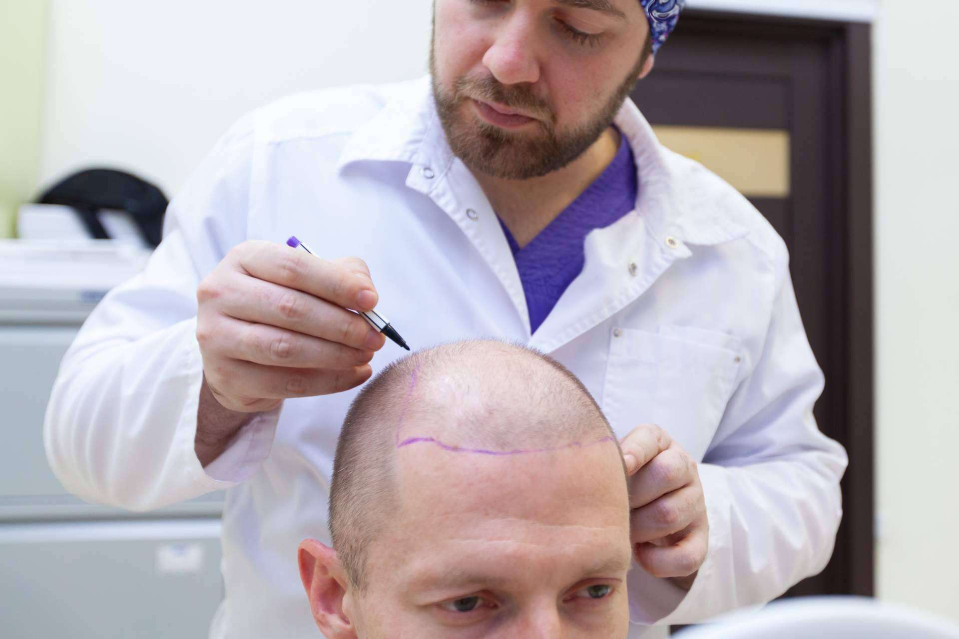 ¿Cómo remediar la caída de pelo hormonal o carencial con el tratamiento efectivo de Géomer?