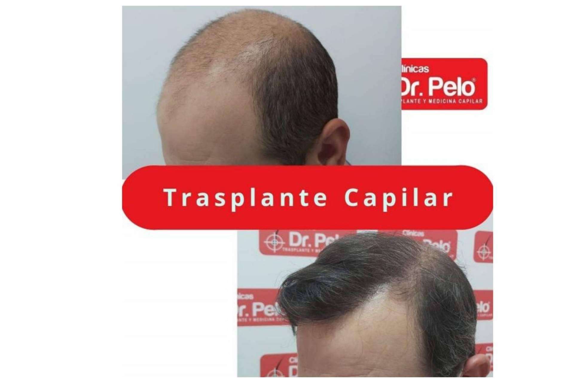 Clínica Dr.Pelo: ¿Cuál es la mejor clínica para someterse a un tratamiento de injerto capilar en Sevilla?