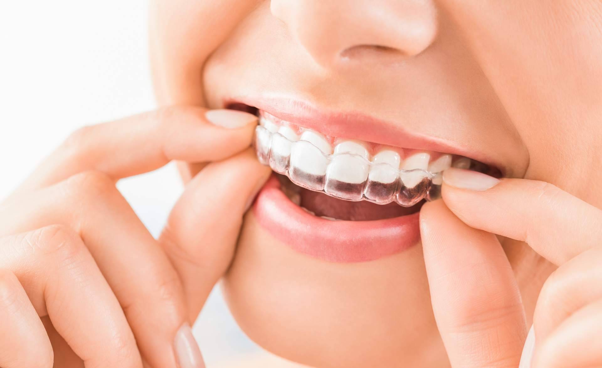 ¿Dónde encontrar tratamiento de implantes dentales y ortodoncia invisible? Clínica Dental Heins