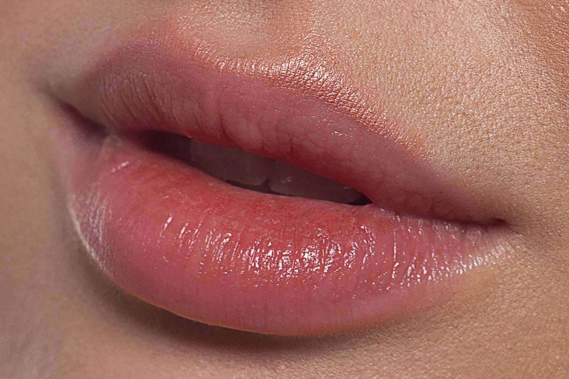 ABB Medicina Estética realiza tratamientos de aumento de labios