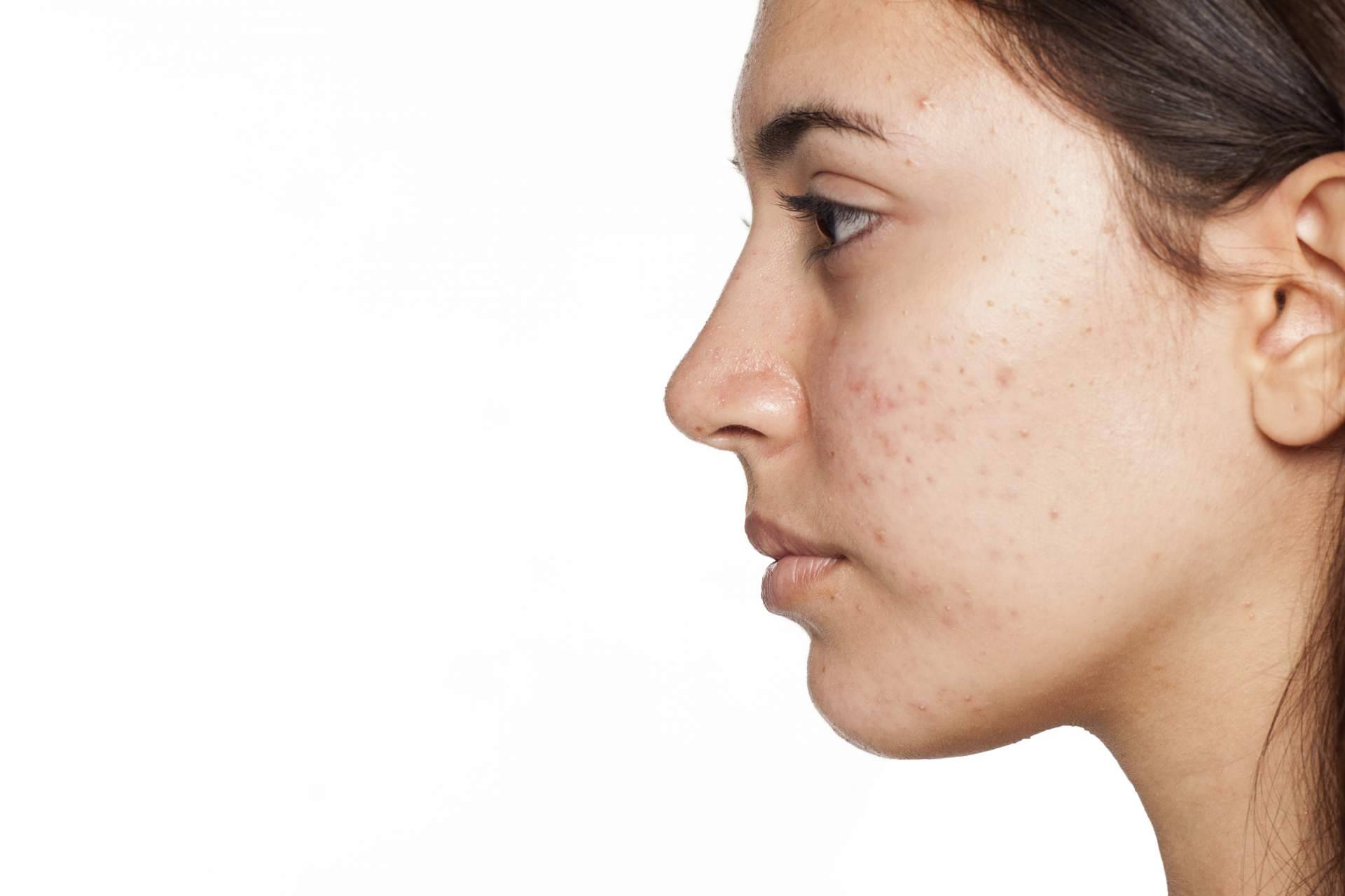AcnéXero, la app de inteligencia artificial fundada por dos dermatólogos que permite terminar con las espinillas y el acné