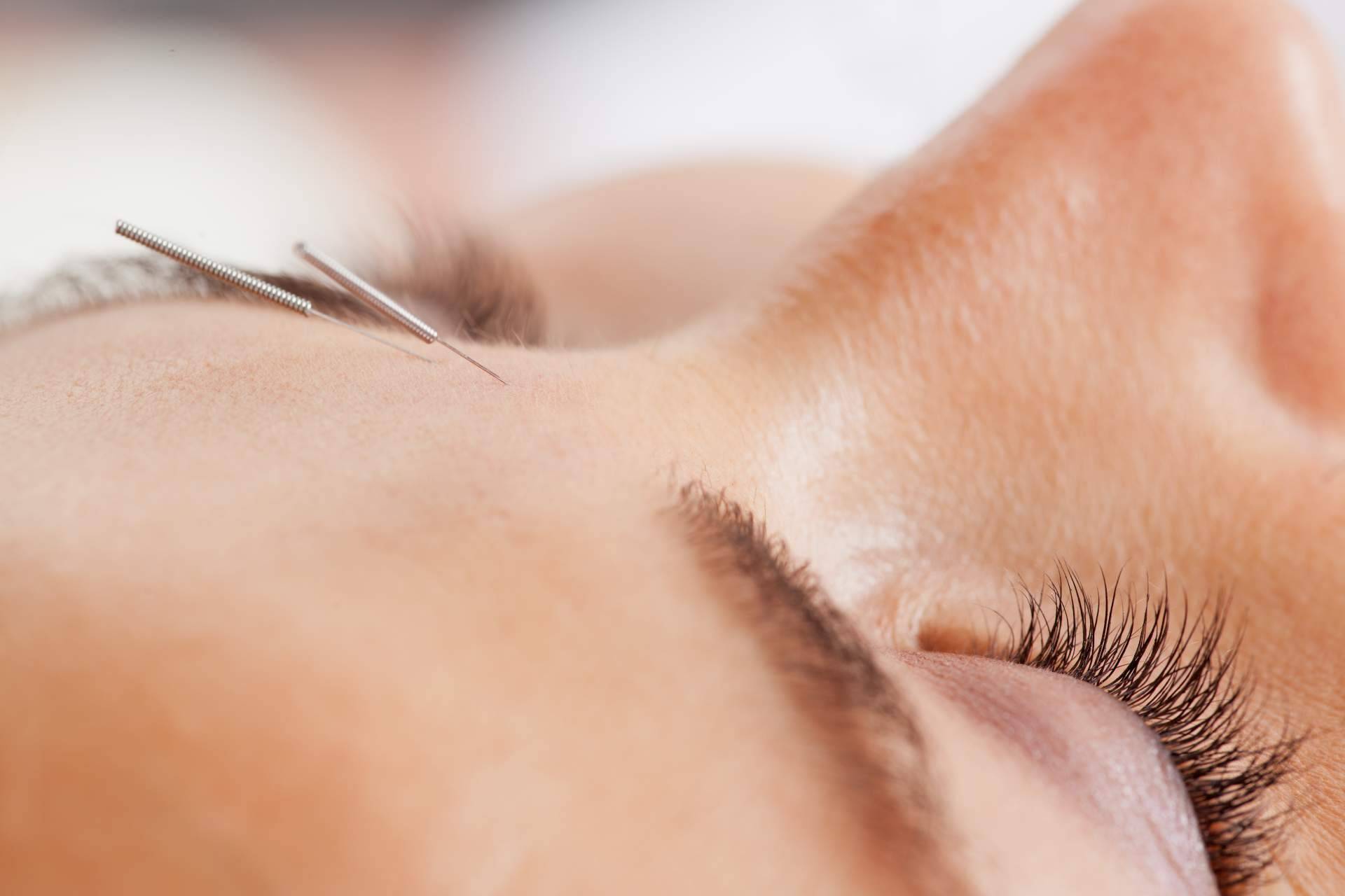 Kikai: acupuntura estética a domicilio por el centro