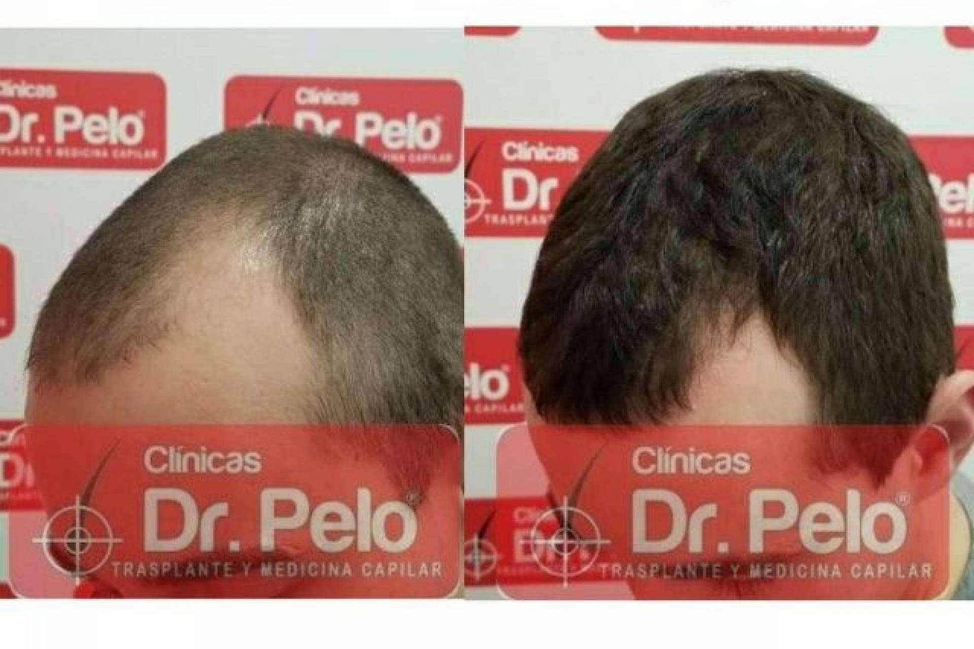 Los beneficios del láser capilar LedHair de Dr. Pelo