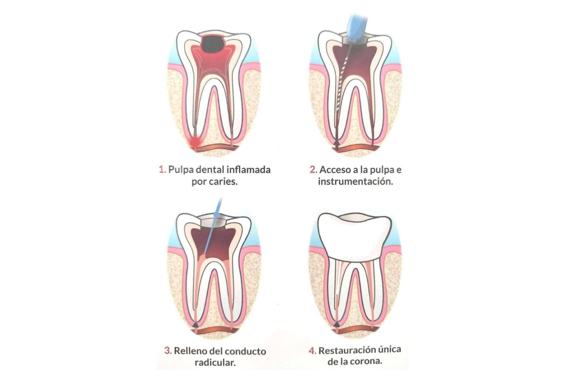 Implant Clinics garantiza resultados satisfactorios en el procedimiento de endodoncia