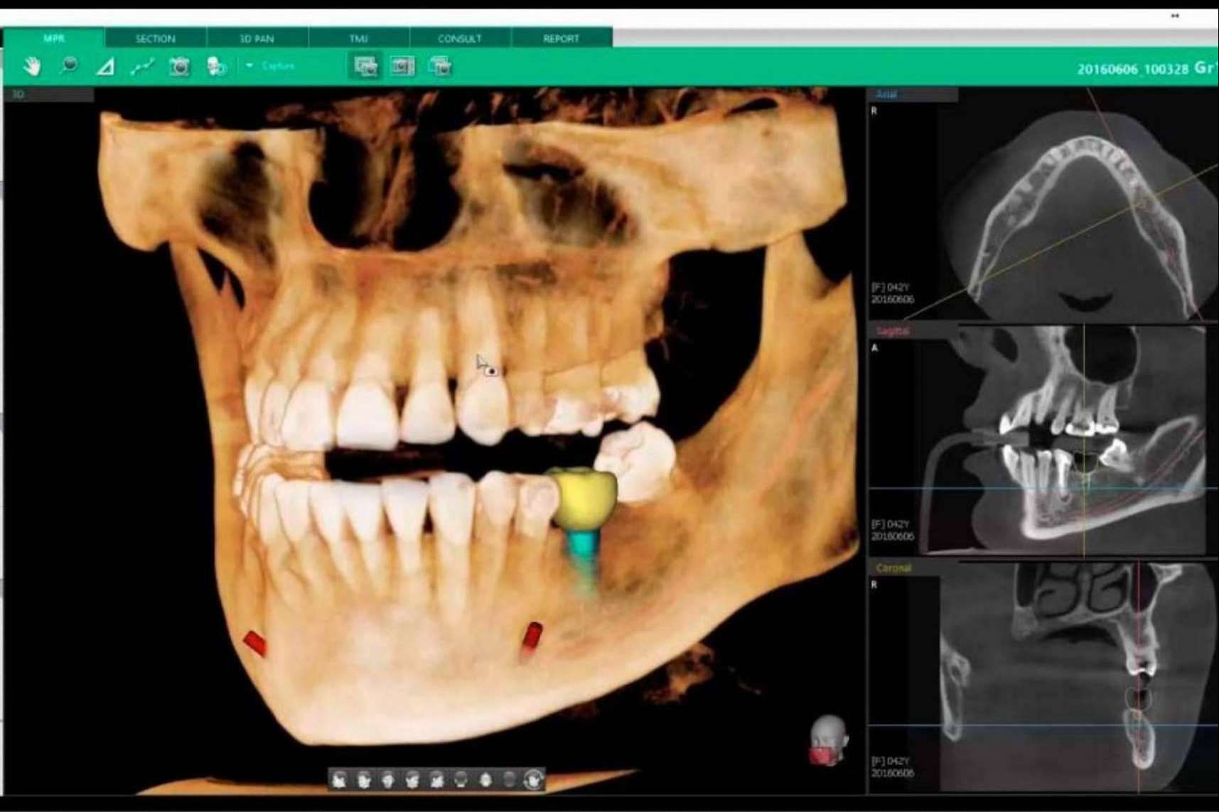 Odontología digital en Clínica Blay Monzó: las técnicas avanzadas en implantología
