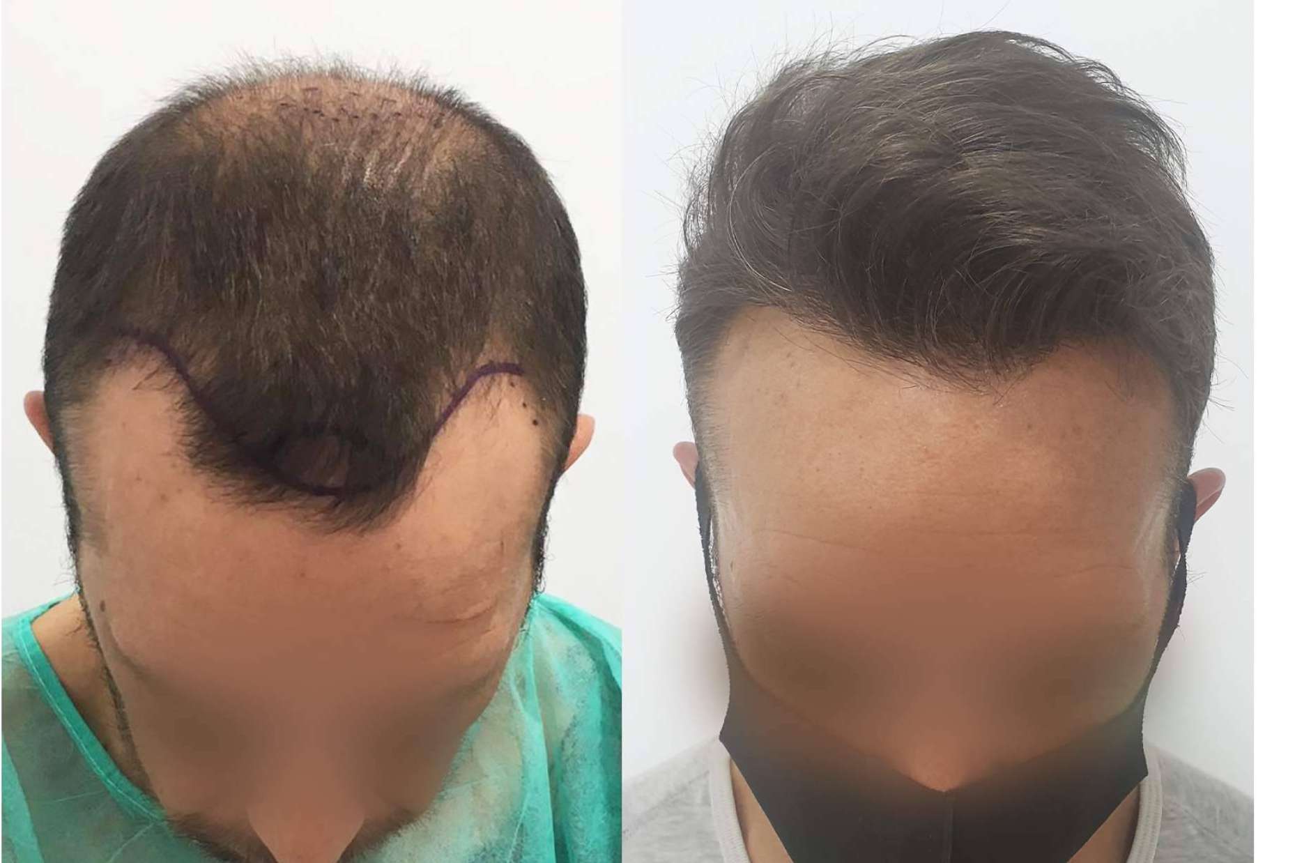 Los famosos también apuestan por el injerto capilar, por la clínica Injermur