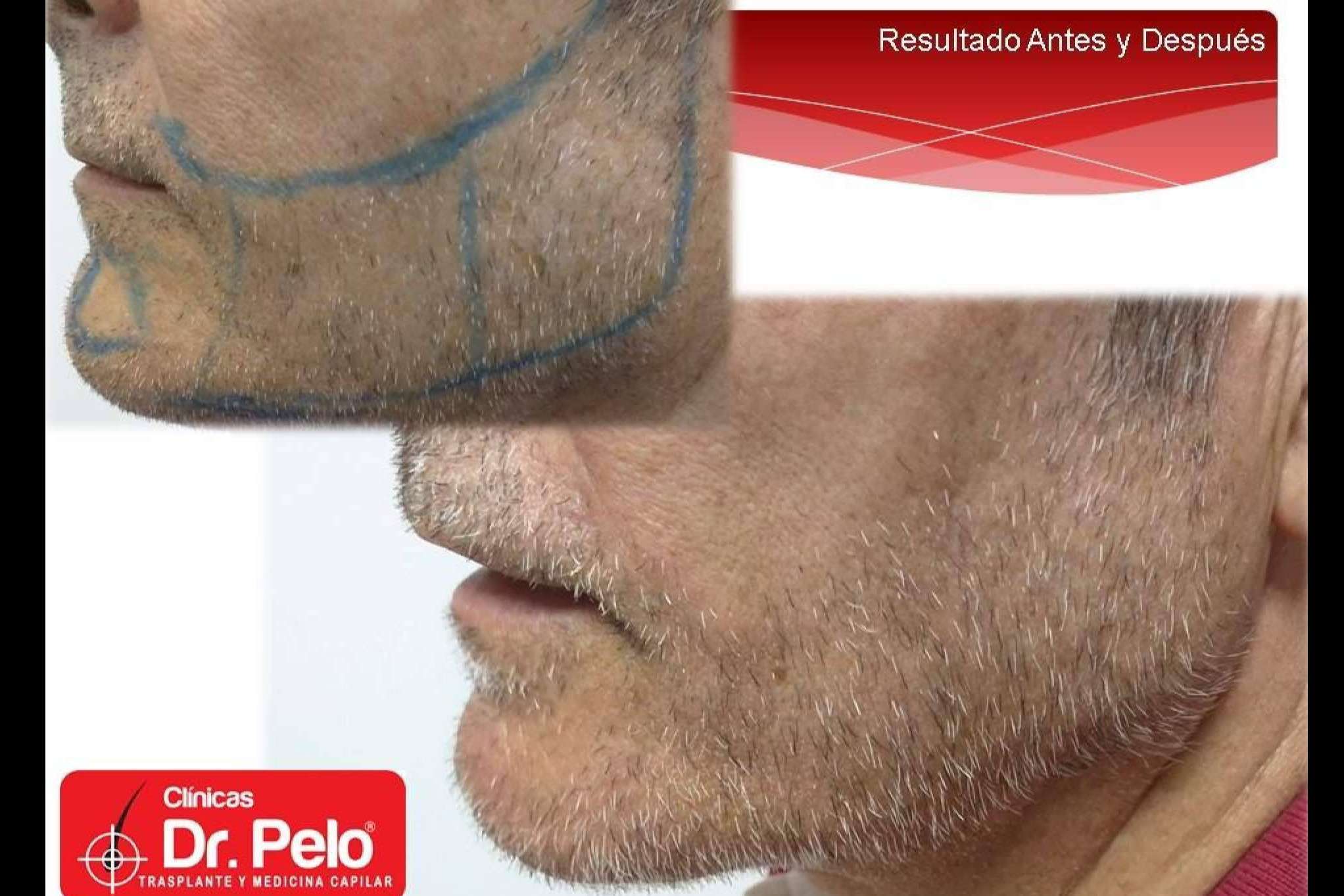 El trasplante de barba de Clínicas Dr. Pelo, uno de los tratamientos con resultados más eficaces