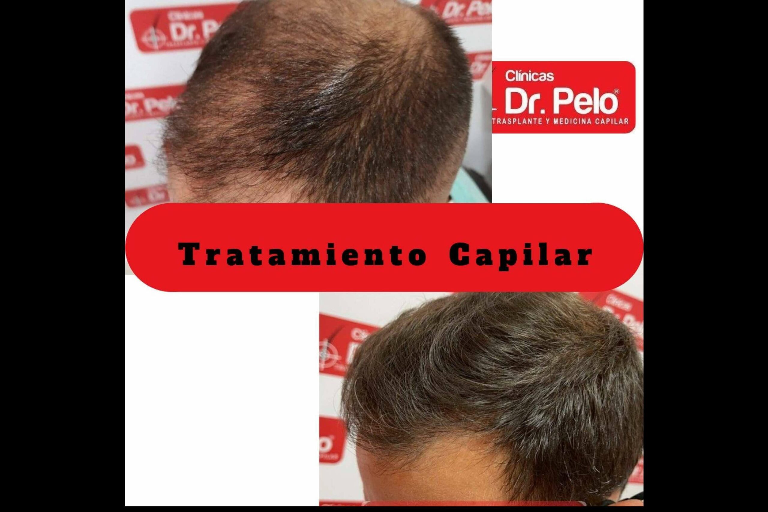 Tratamientos capilares de todo tipo en la red de Clínicas Dr. Pelo