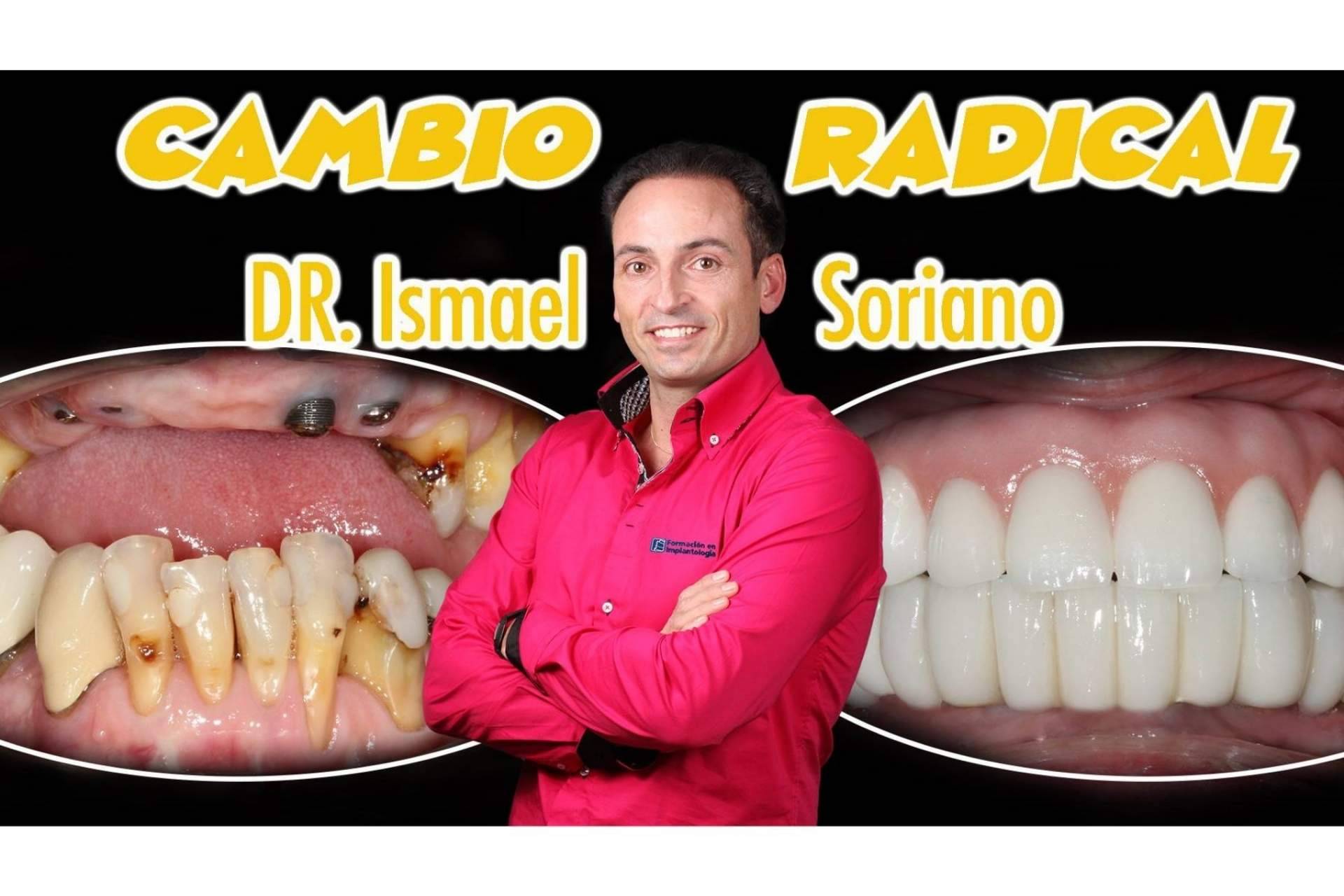 Los pacientes encuentran múltiples ventajas en la técnica de implantes con dientes inmediatos del Dr. Ismael Soriano