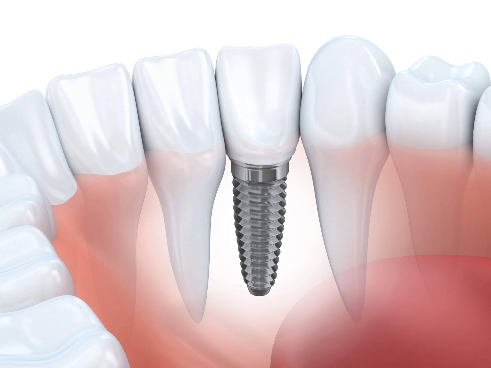 El procedimiento de implante dental de titanio en Sevilla que realiza Clínica Dental Helident
