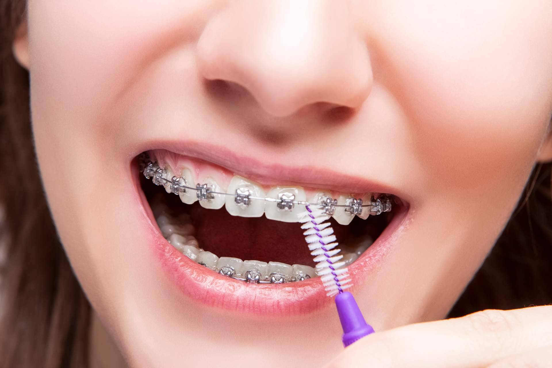 Clínica Sonrisas ofrece servicios de ortodoncia Insignia en Badajoz