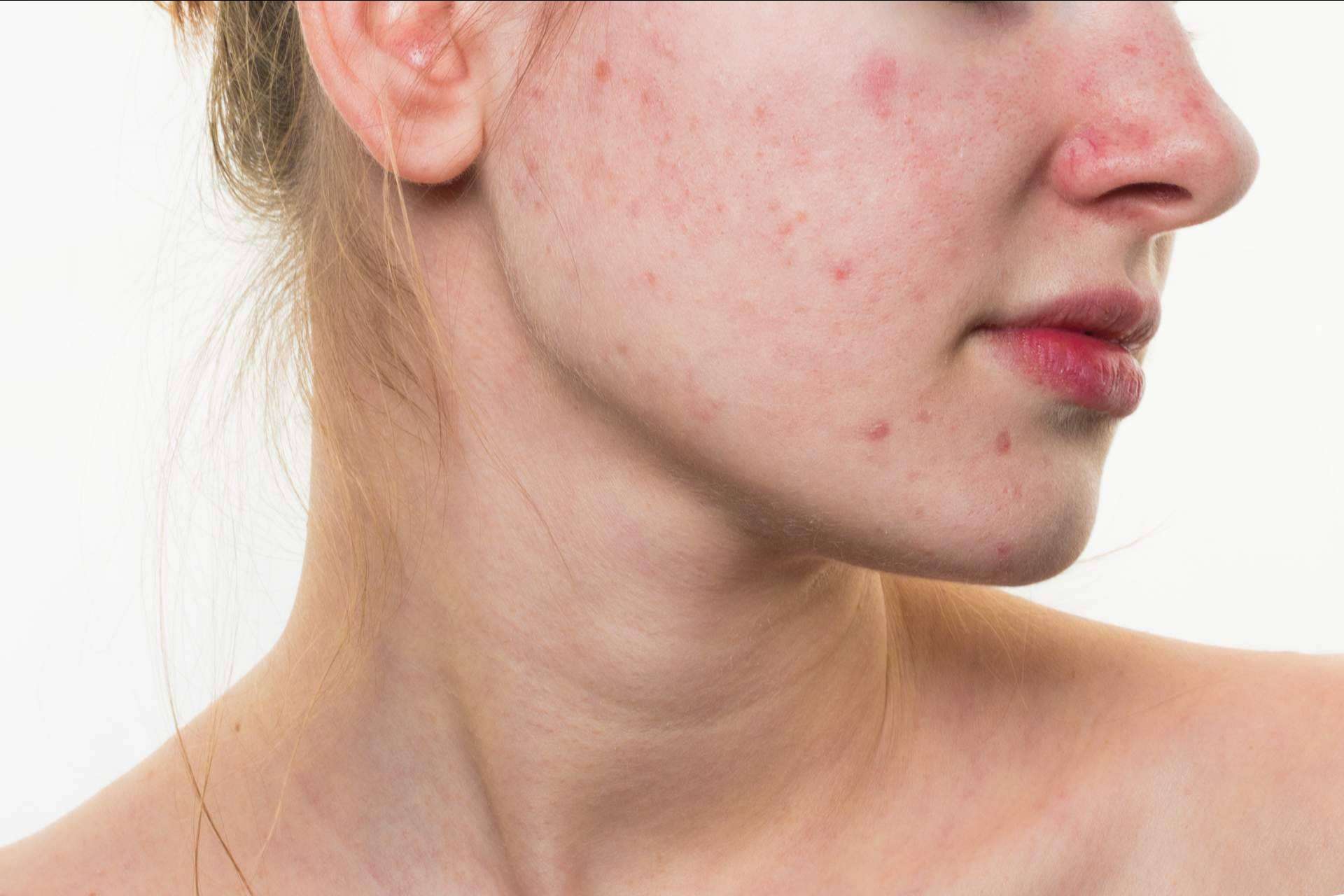 AcnéXero, la aplicación fundada por dermatólogos que propone soluciones efectivas para combatir el acné
