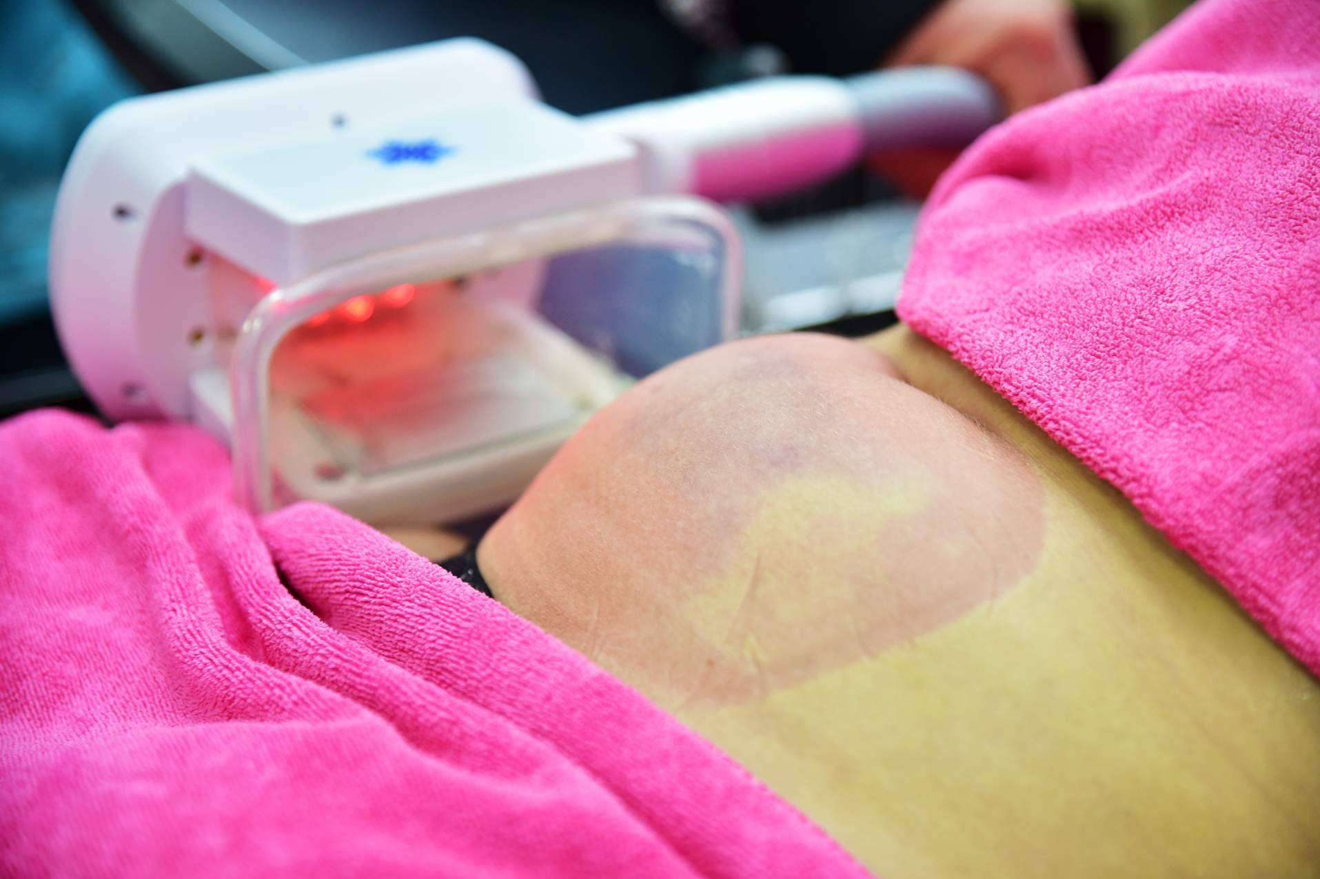 ¿Comporta la criolipolisis algún tipo de peligro para los pacientes? Unidad Femme