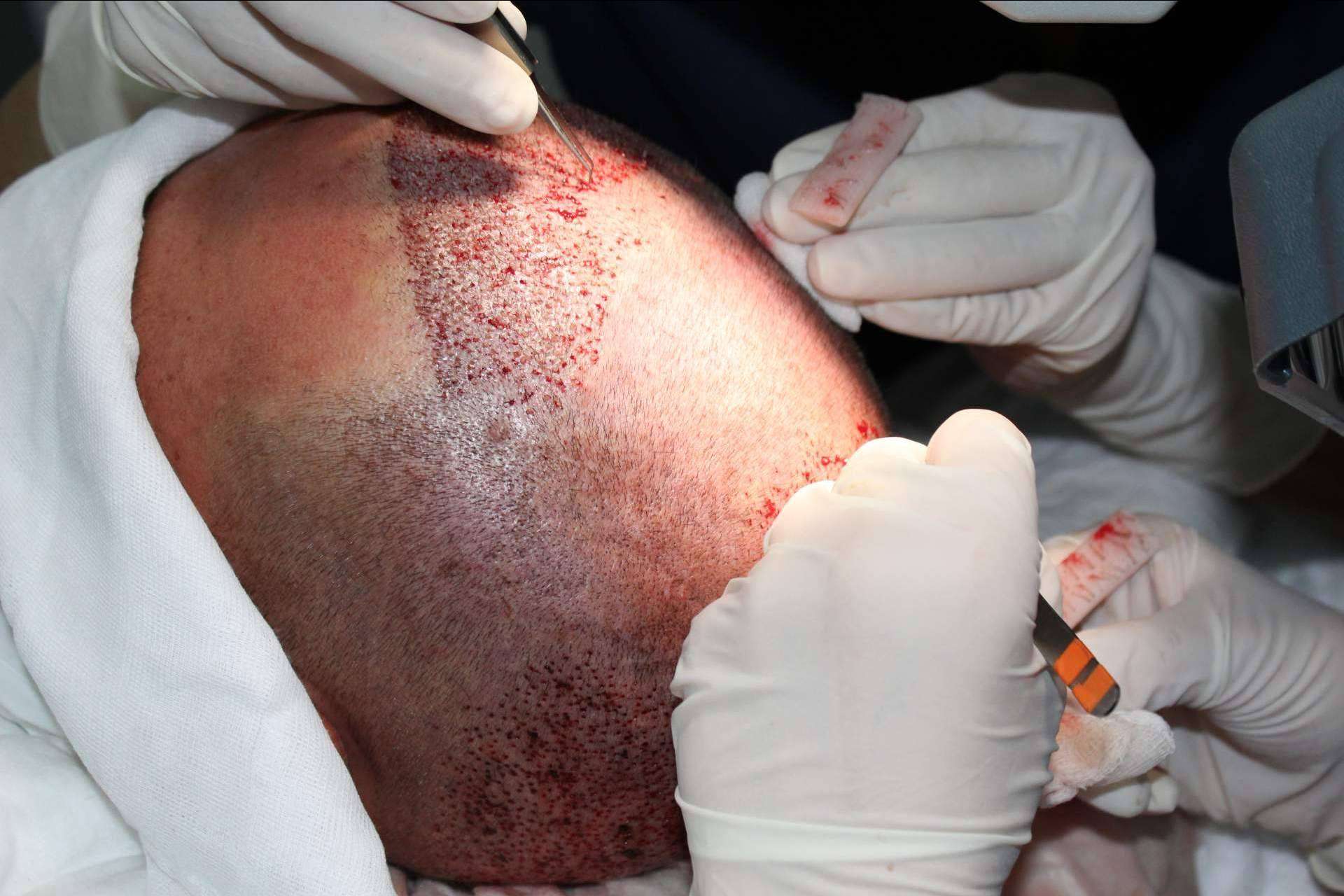 Injermur, la clínica de injerto capilar en Murcia especializada en el injerto sin cicatriz