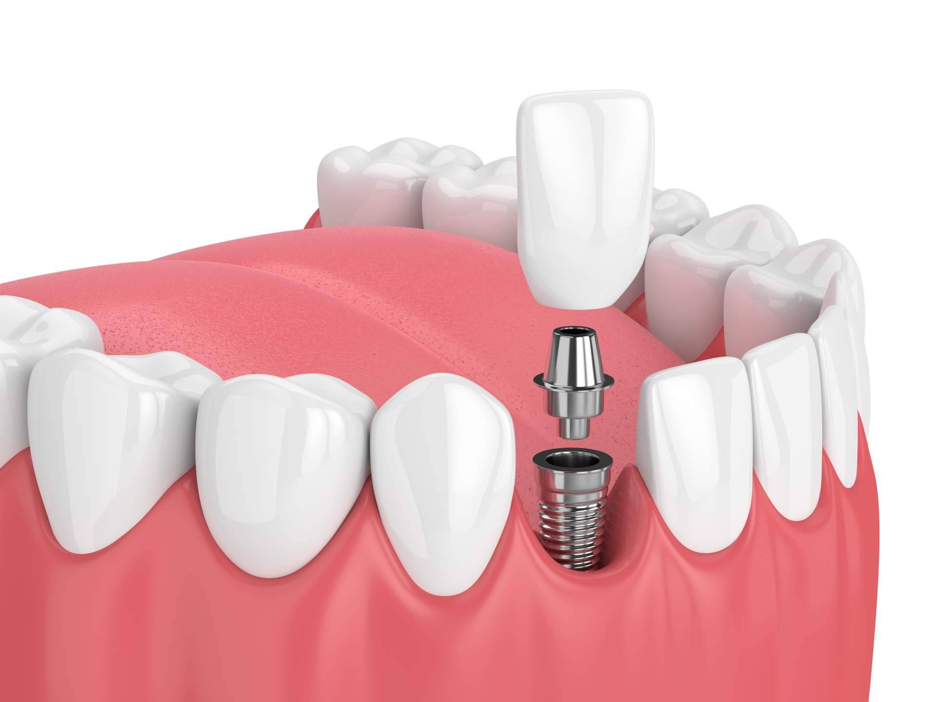 Implantes dentales innovadores en Hospitalet con Clínicas Qualident