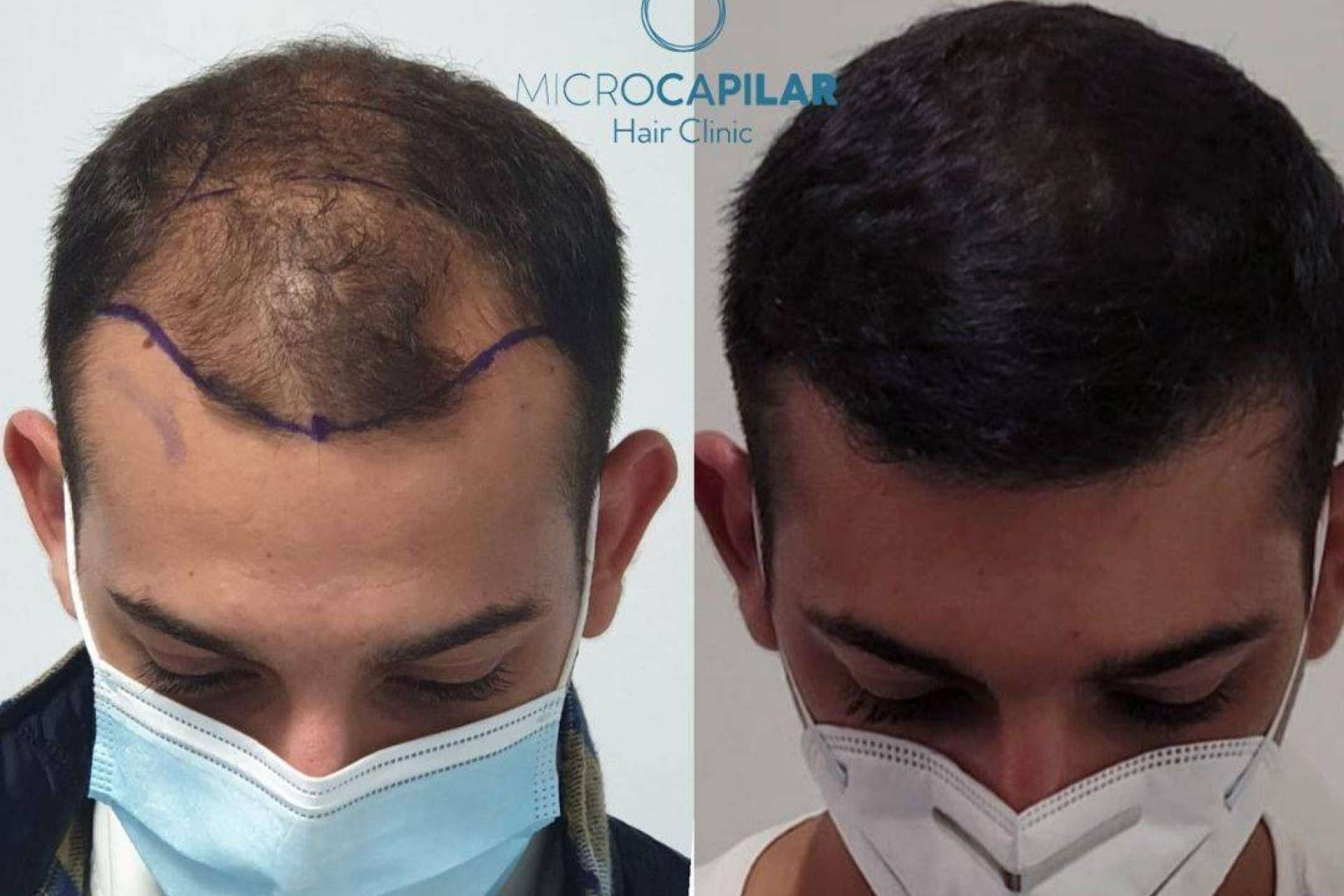 Microcapilar Hair Clinic es un buen lugar para realizarse un injerto capilar con máxima extracción folicular