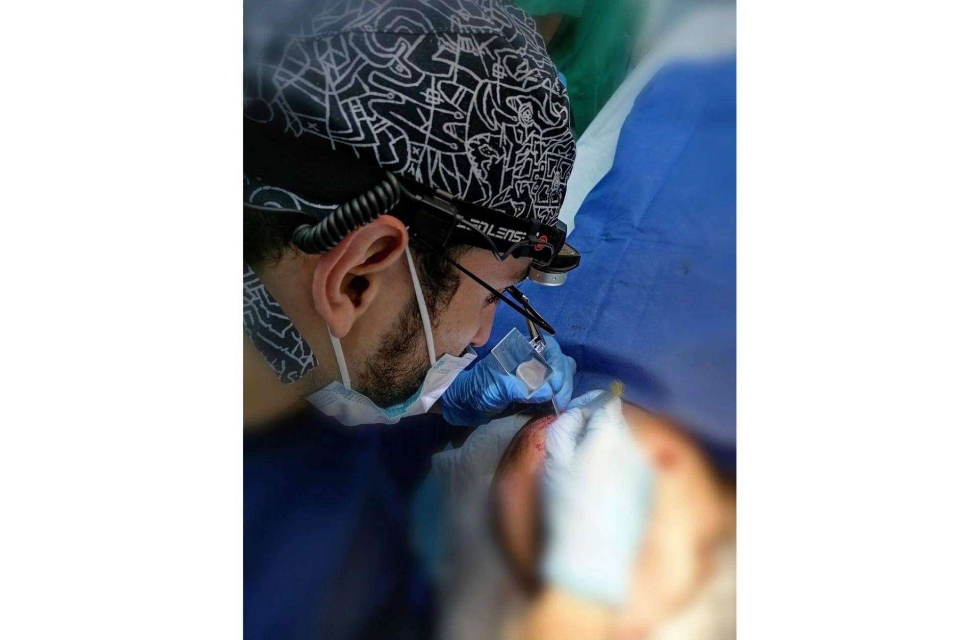 Tratamientos con el método DHI para retrasar el efecto de la calvicie, cuya clave del éxito es la dedicación