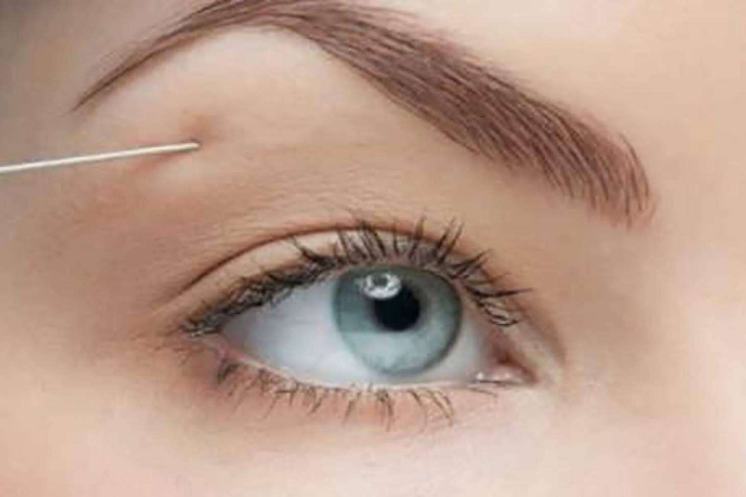 La Clínica de Medicina Estética Sánchez Peral en Castellón lleva a cabo diseño de cejas con bótox