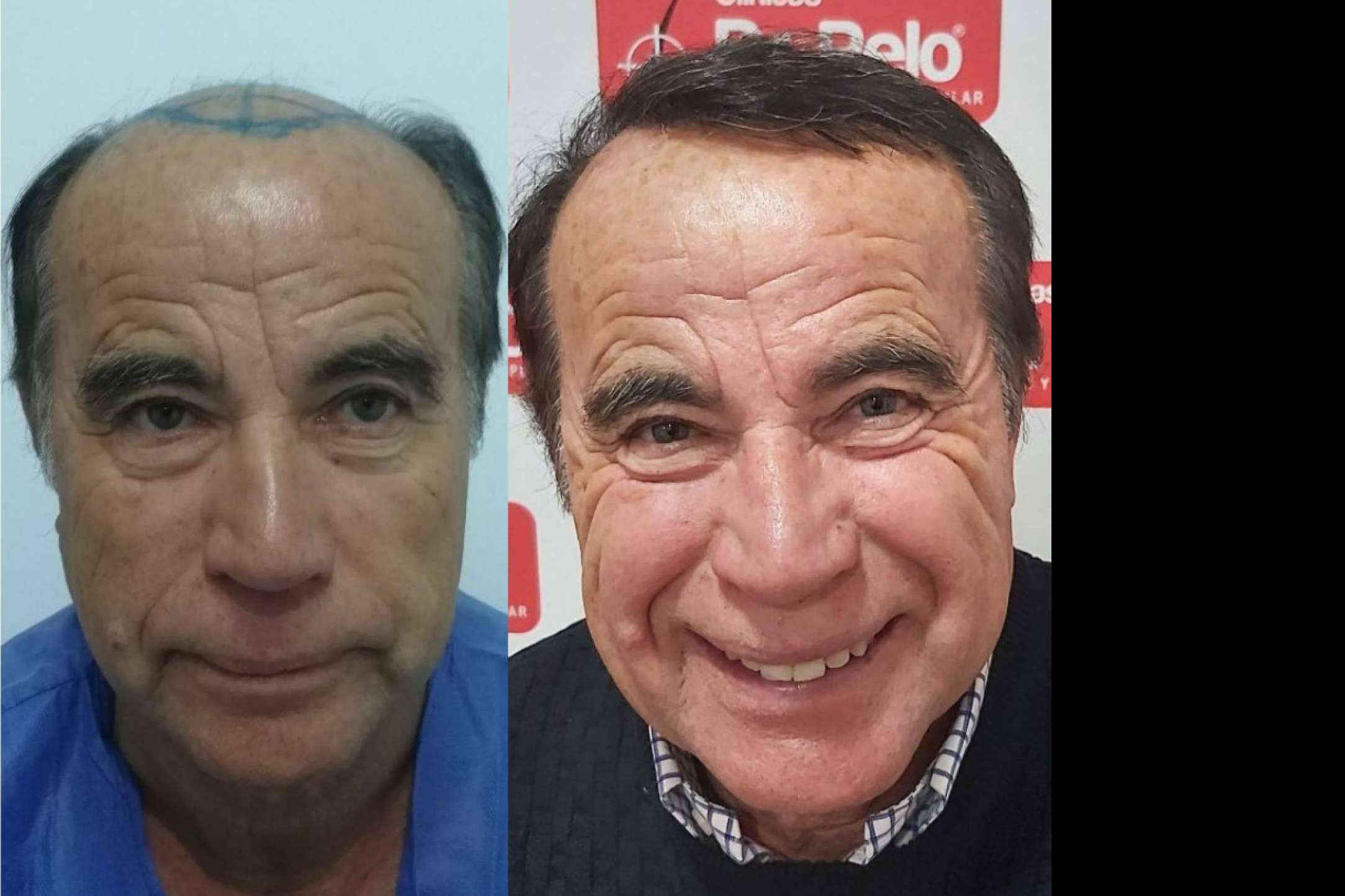 La importancia de conseguir trasplantes capilares efecto natural, por Clínicas Dr. Pelo