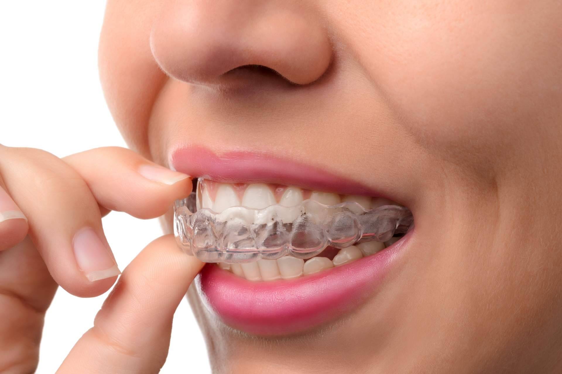 Invisalign de la mano de DeltaDent