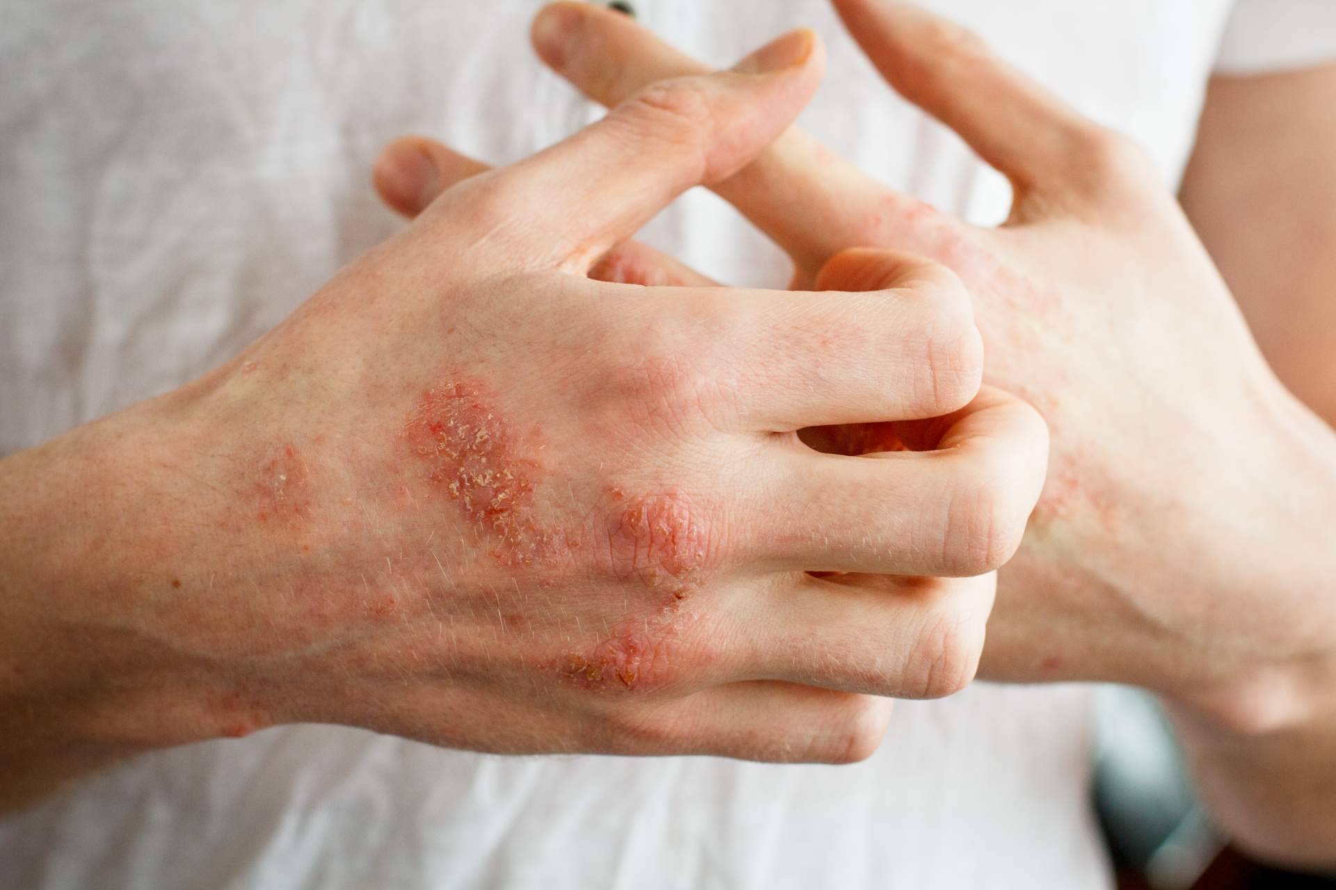 ¿Cómo se diferencia un eczema atópico de un eczema de contacto?, por Laboratorio Géomer