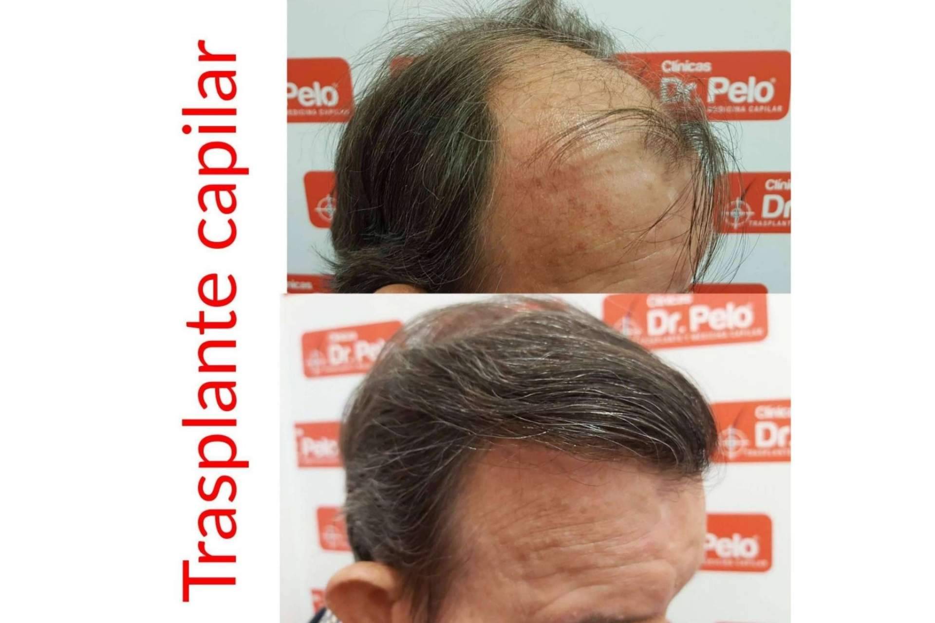 Dr. Afonso Junior ofrece una primera cita online gratuita para realizar la Técnica Progresiva Capilar