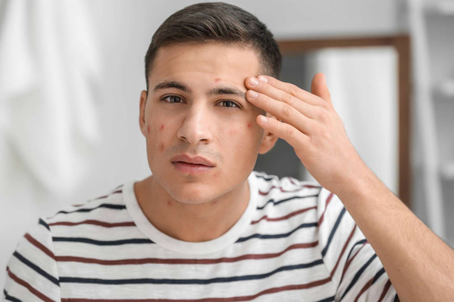 ¿Cuáles son los beneficios del tratamiento contra el acné de Bėyo Beauty?