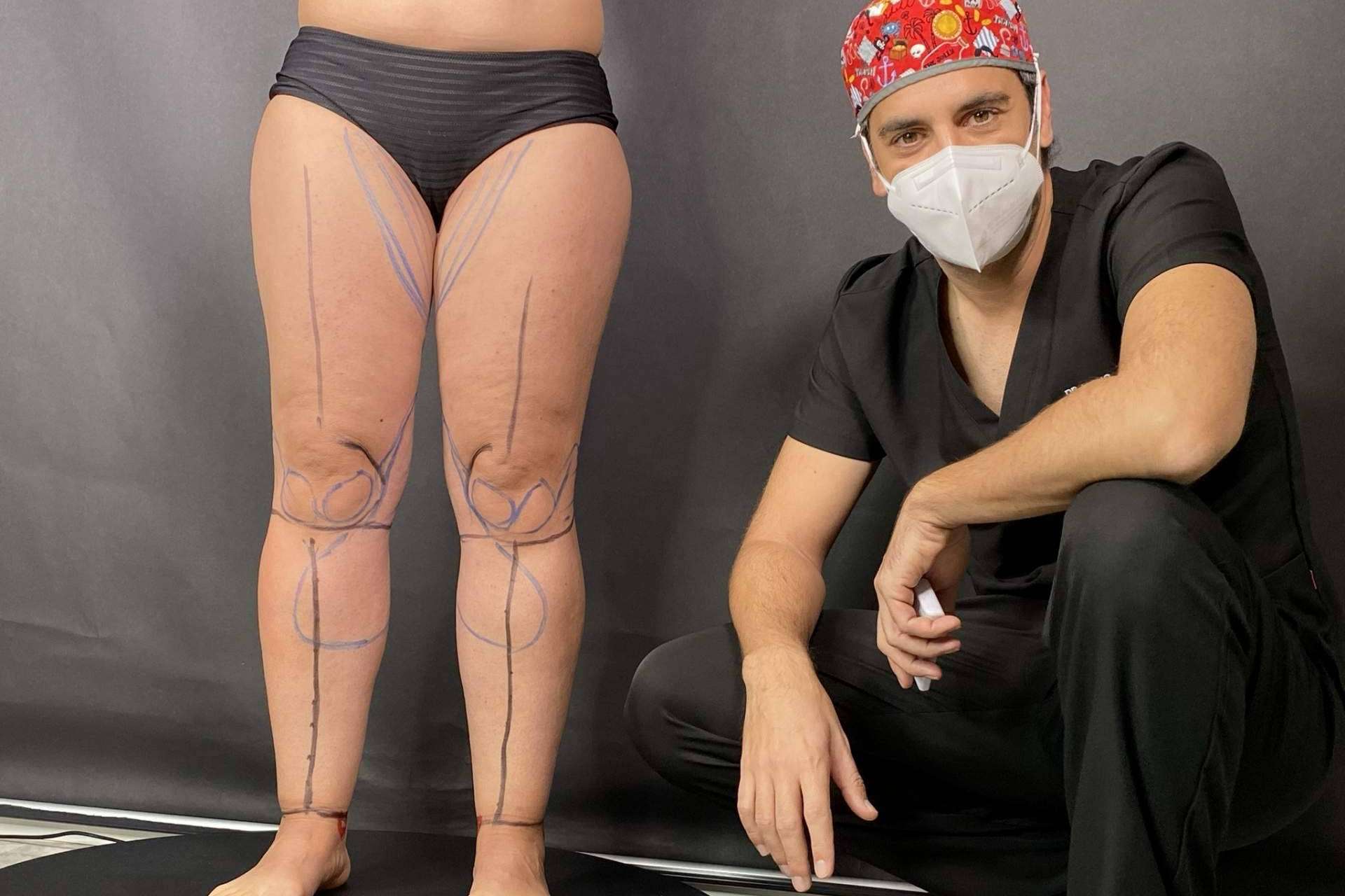 IVALI, nace el Instituto Valenciano de Lipedema