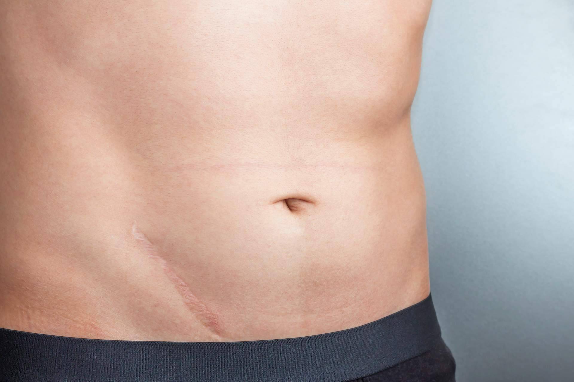 La importancia de la fisioterapia y la osteopatía en el tratamiento de cicatrices y liberación de adherencias