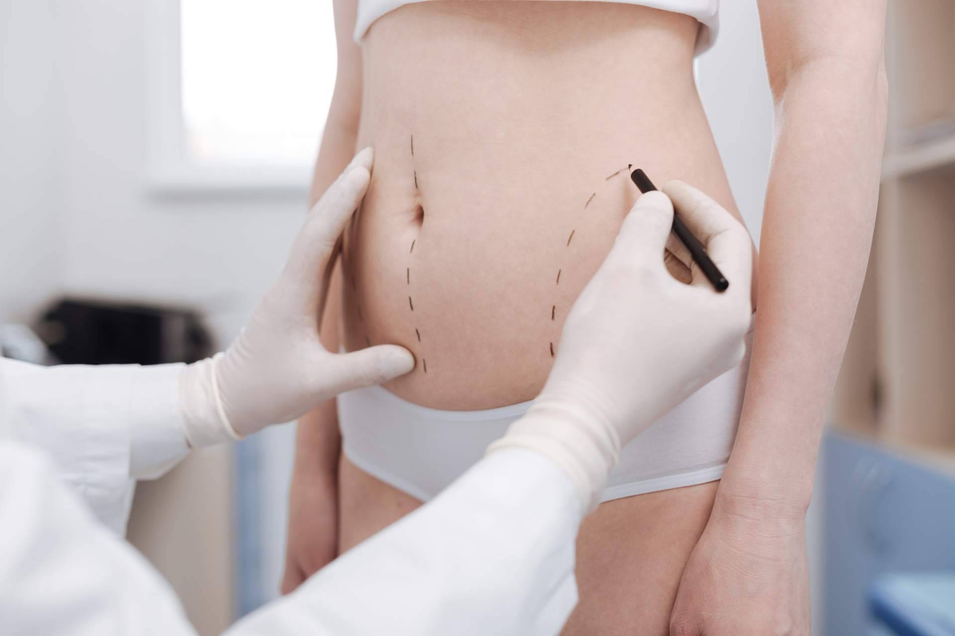 Los efectos del tratamiento de Velashape III de la Dra. Rigo