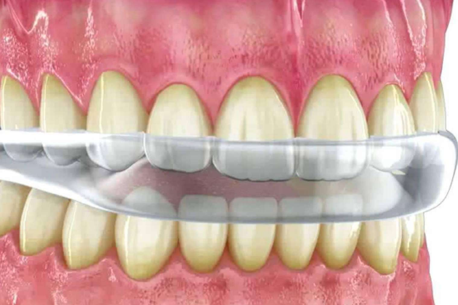Implant Clinics explica las causas y el tratamiento del bruxismo