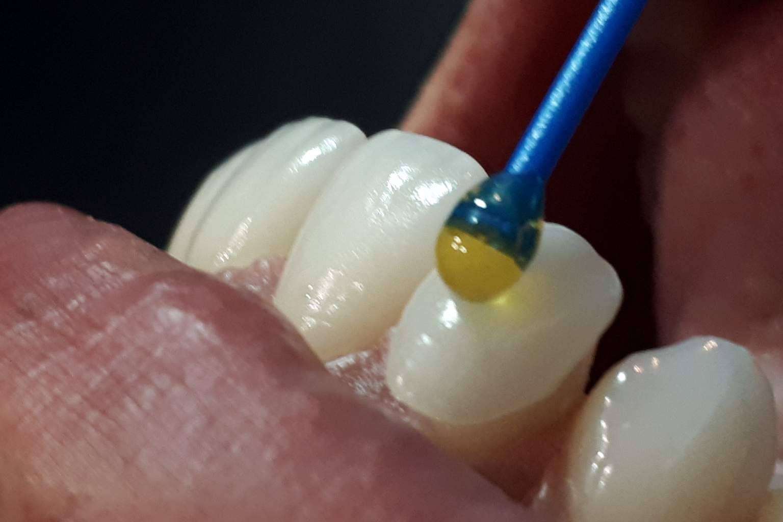 Coronas dentarias impresas con tecnología 3D en una hora, con Dentinova