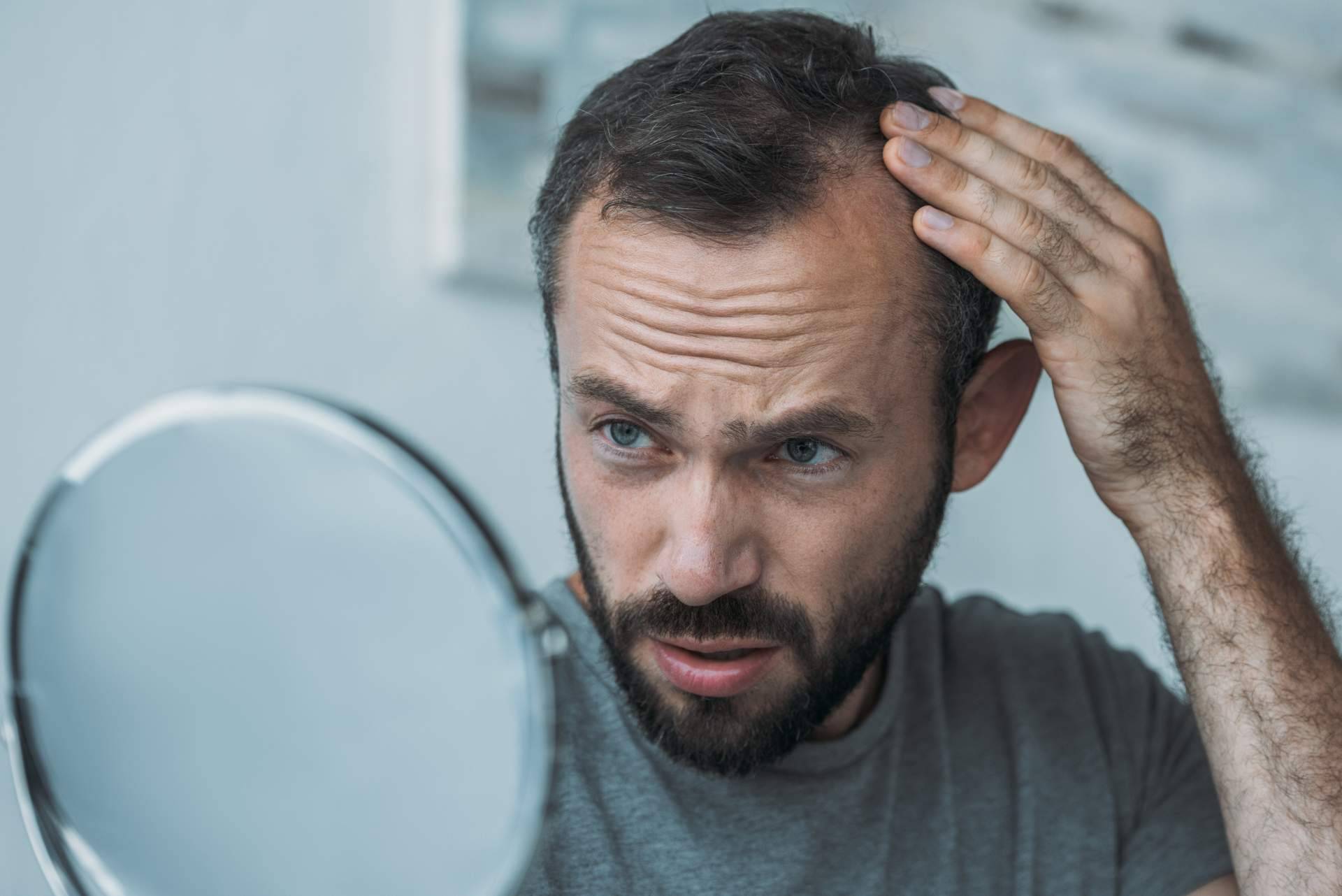 Saw Palmetto para tratar la alopecia androgénica