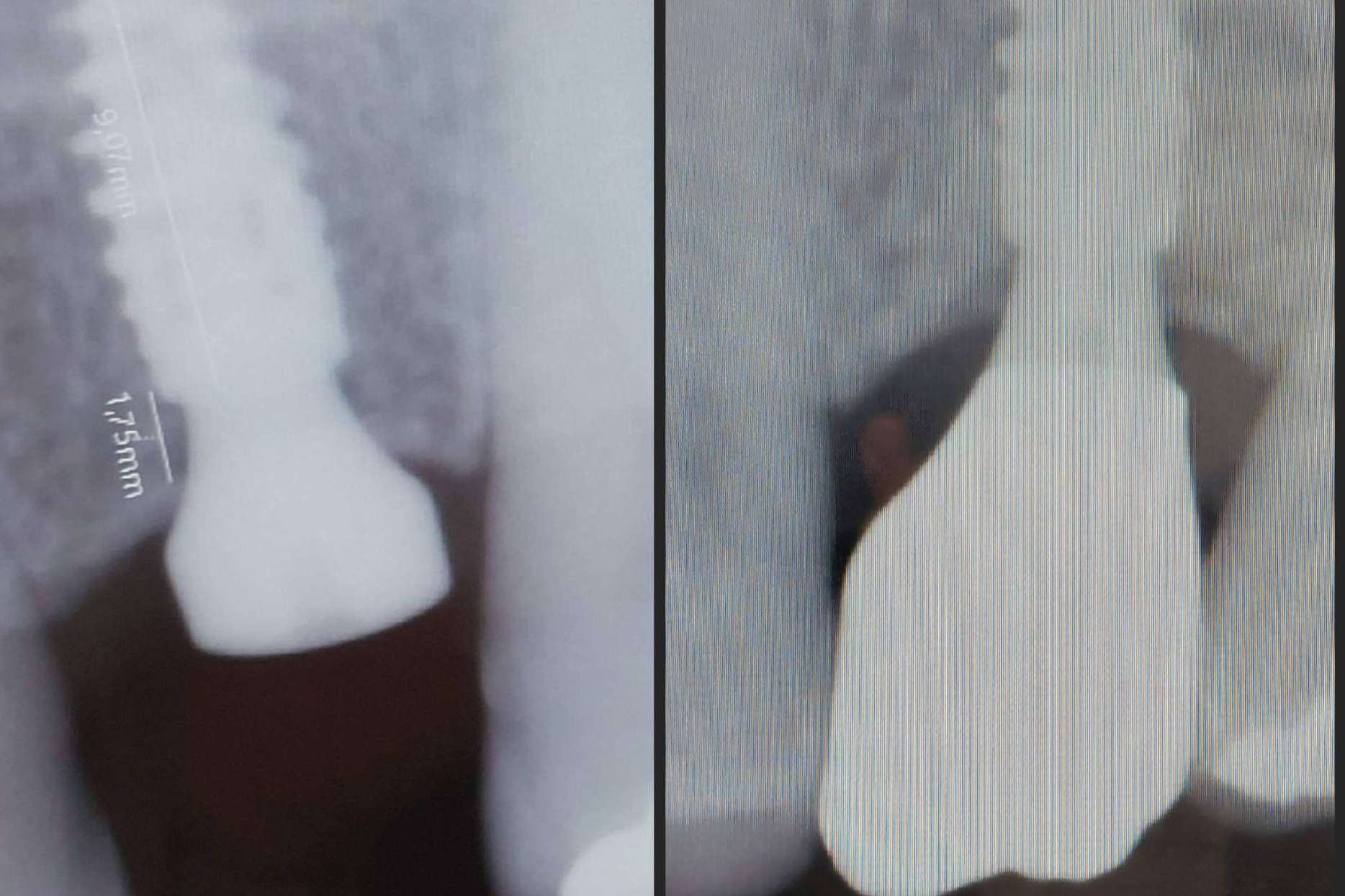 Realizar implantes dentales en un día es posible con la tecnología digital de Dentinova