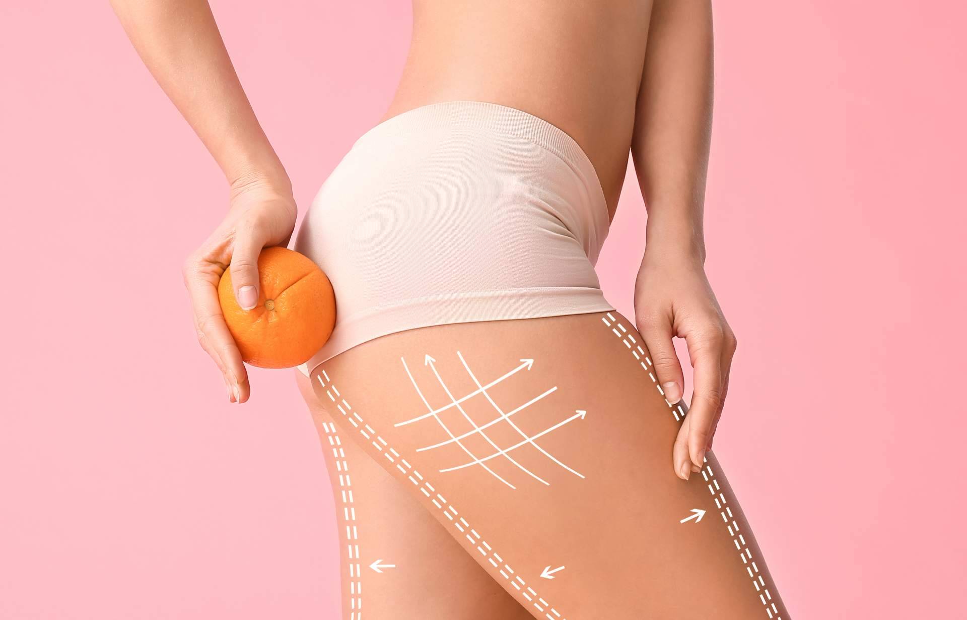 6 acciones contra la celulitis, por el Laboratorio Géomer