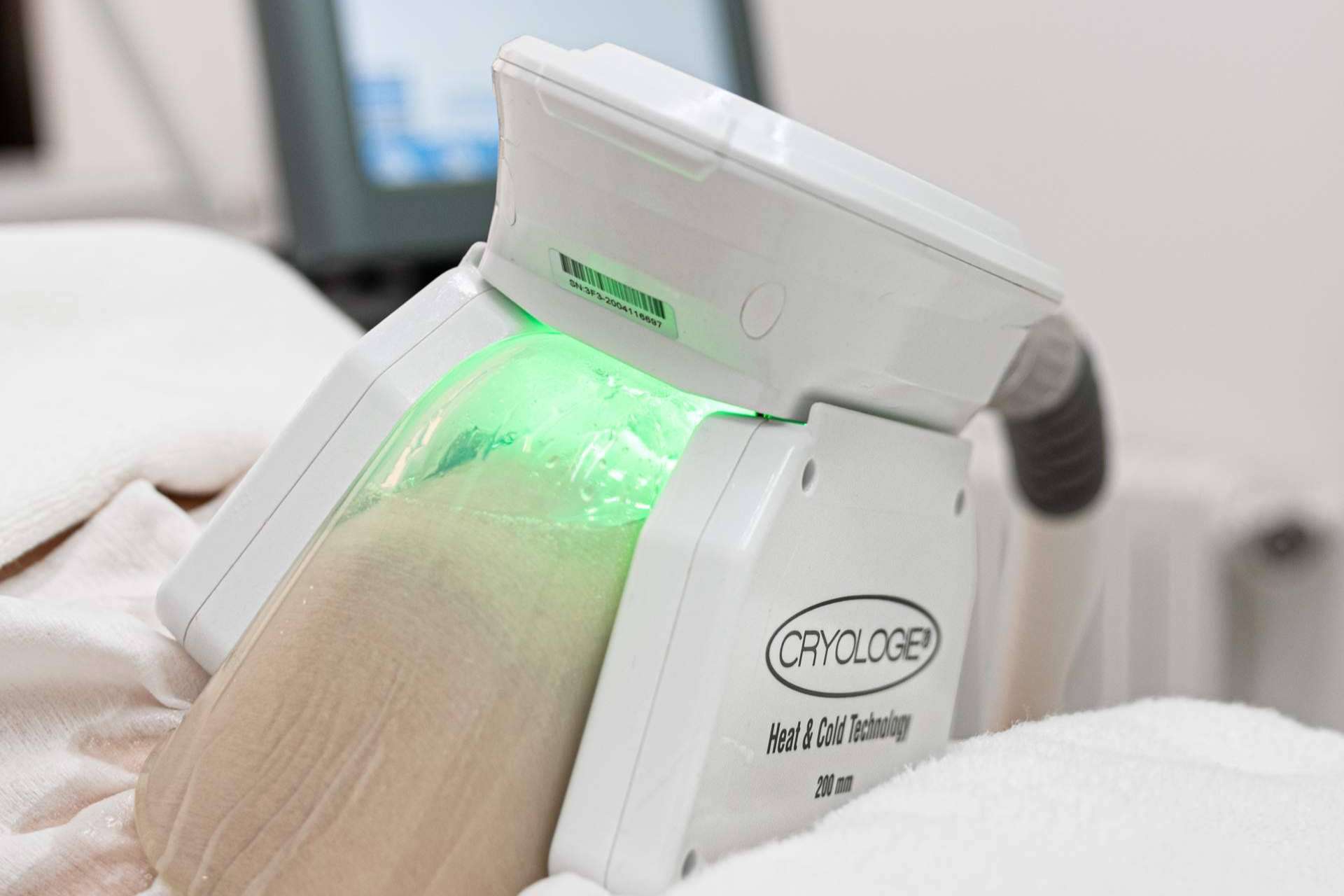 Tratamientos combinados de criolipólisis y estimulación electromagnética para reducir la grasa localizada