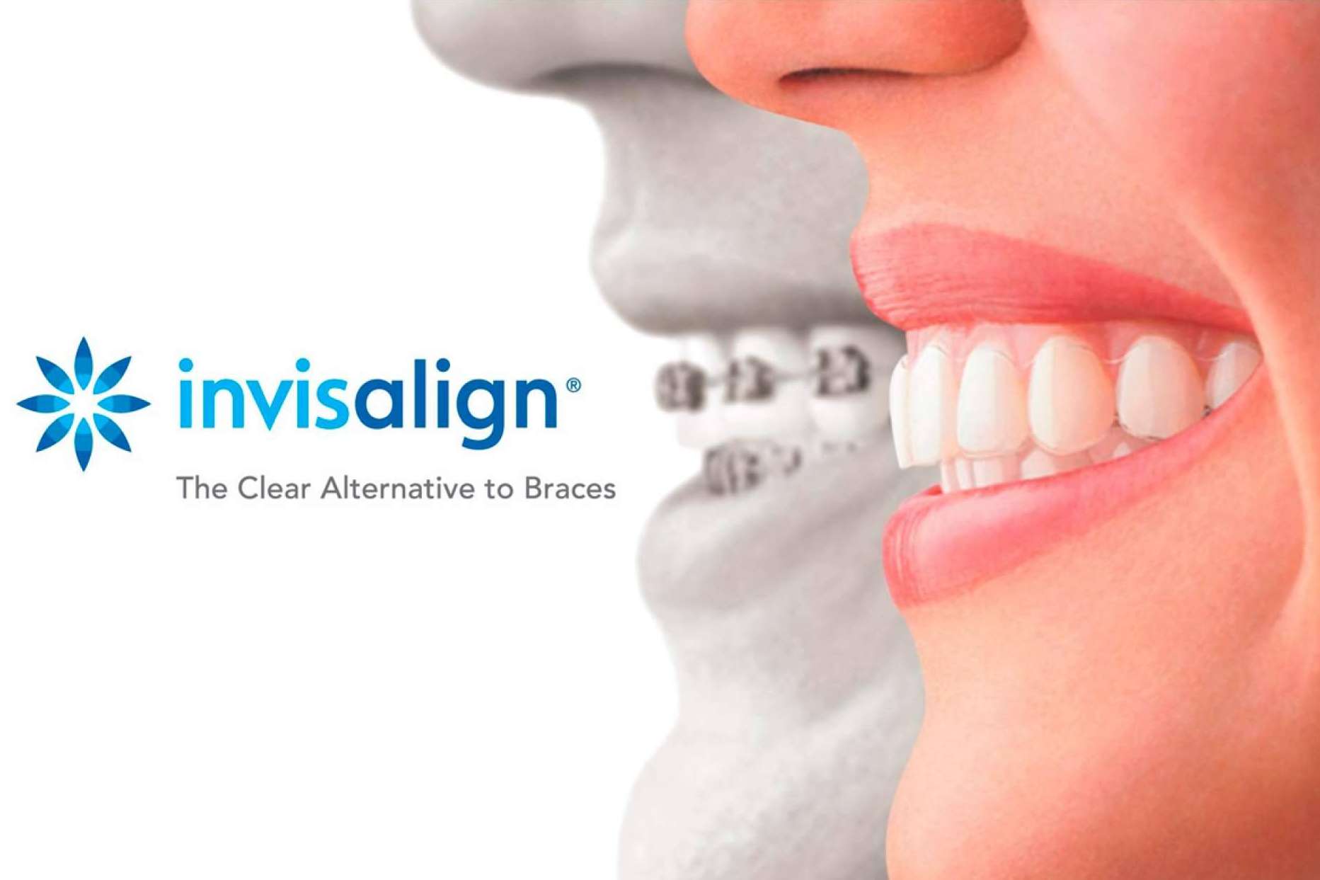 Invisalign, la ortodoncia invisible que garantiza comodidad y estética