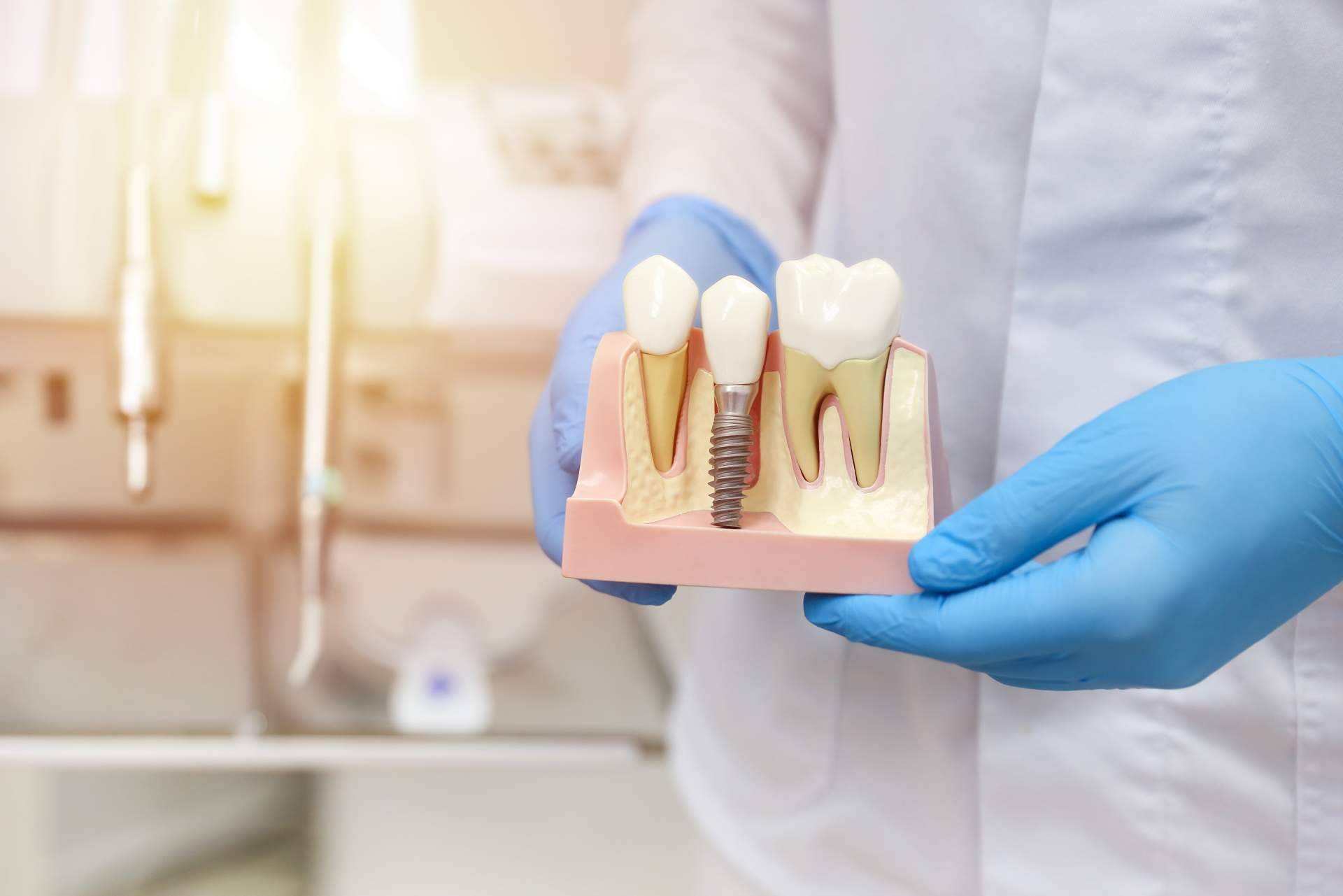 Implantes postextracción con carga inmediata, la técnica de Clínica Dental Sonrisas para lograr una dentadura excelente en sus pacientes