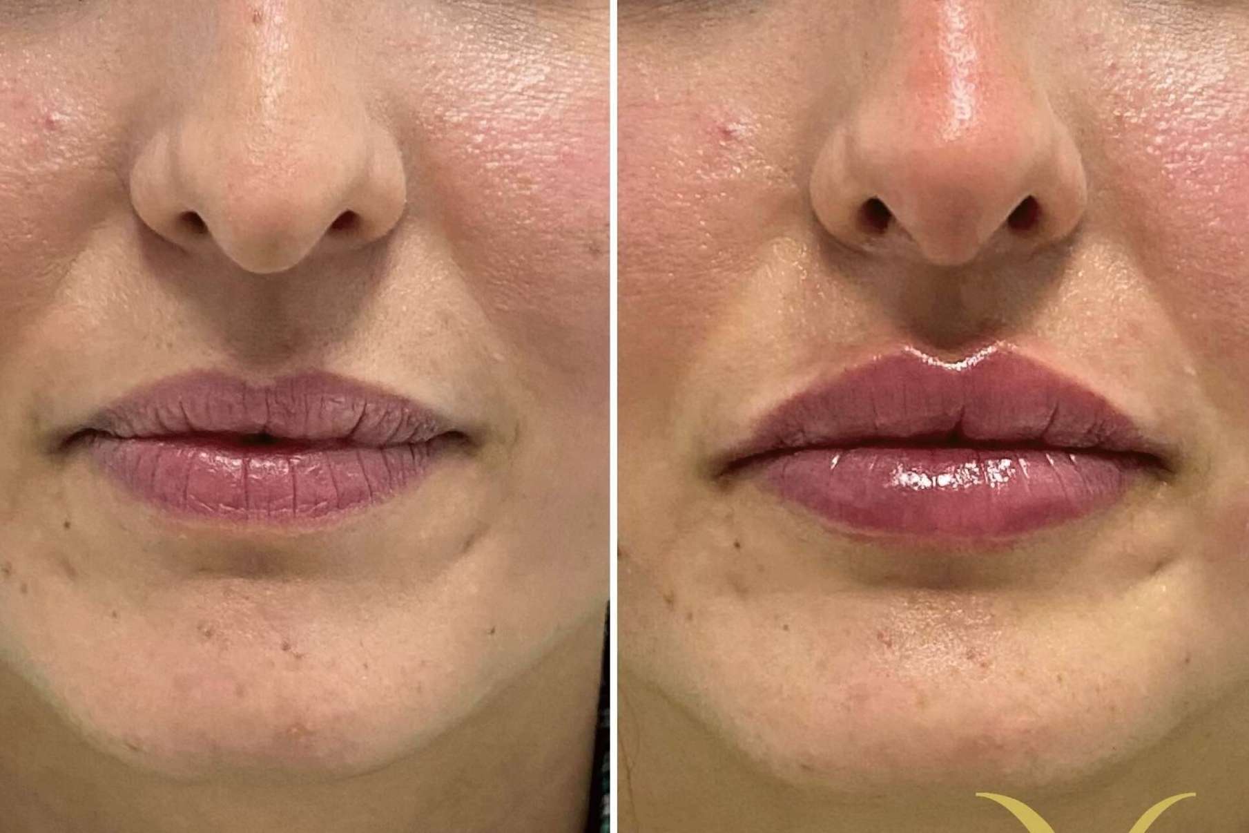 La técnica, Adiblips, de la Clínica Yasmin para el aumento de labios con ácido hialurónico
