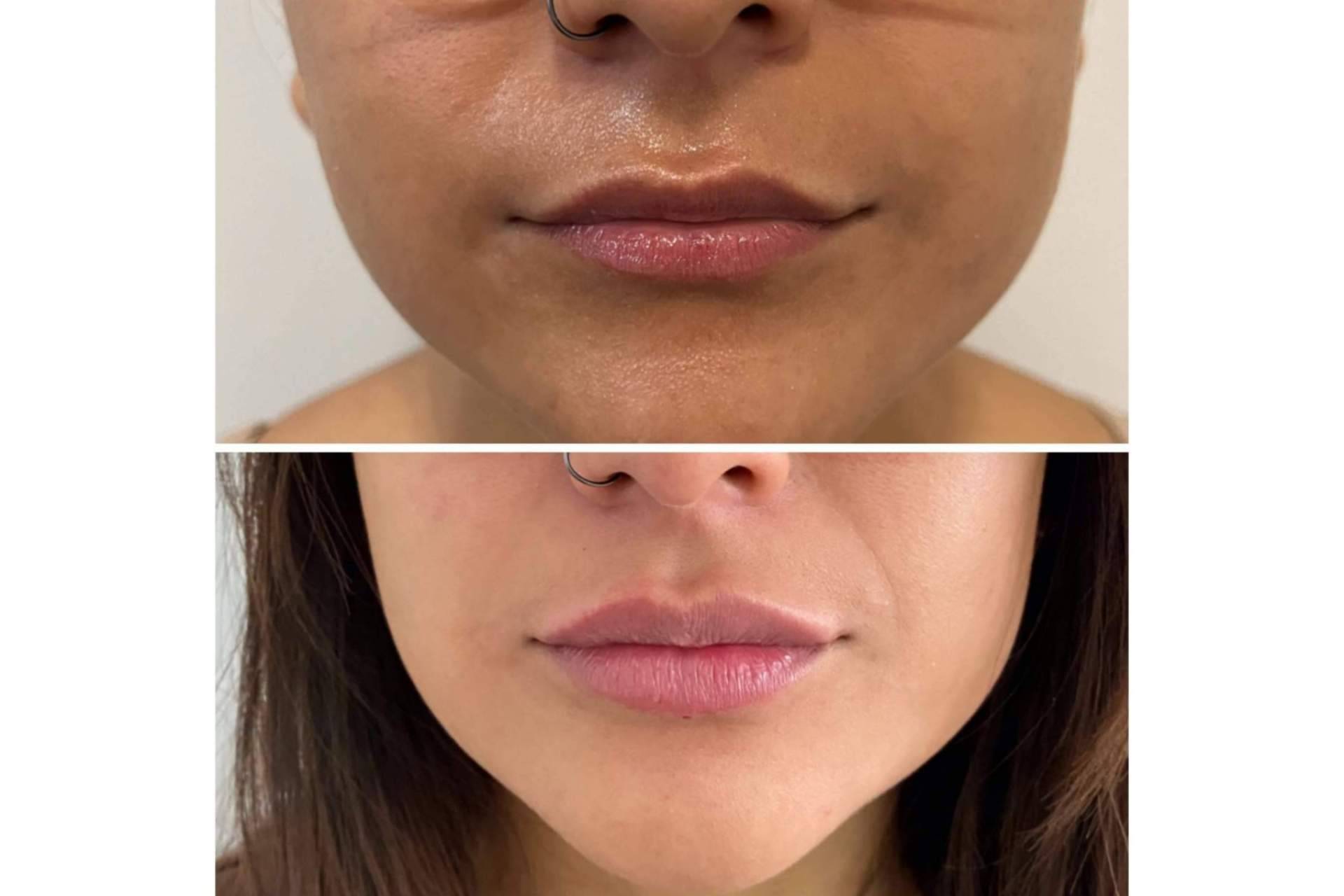 ¿Se puede lograr un aumento de labios en Madrid con resultados naturales?, por la Dra. Cecilia Arthur