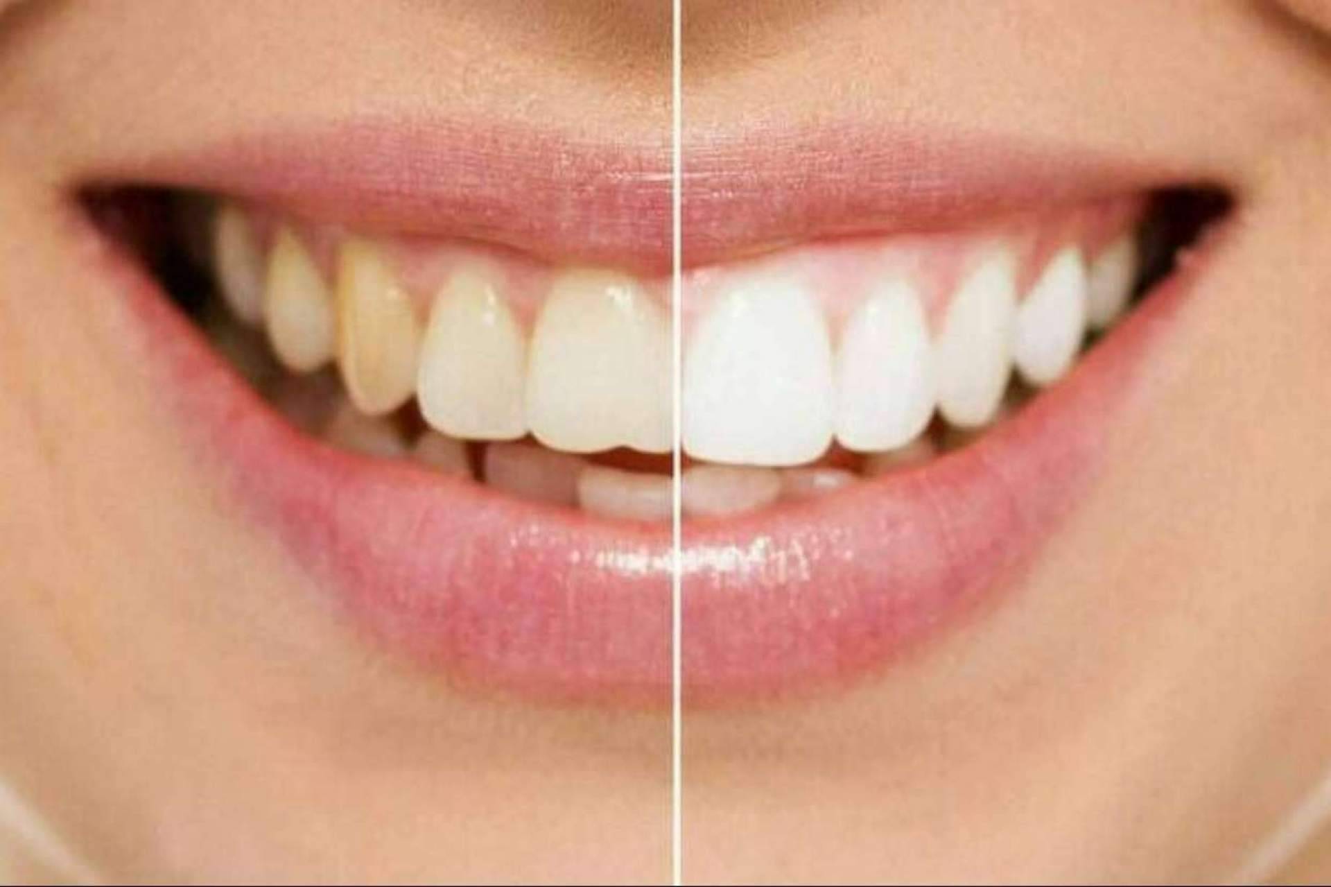 Escoger carillas o blanqueamiento para conseguir una sonrisa perfecta