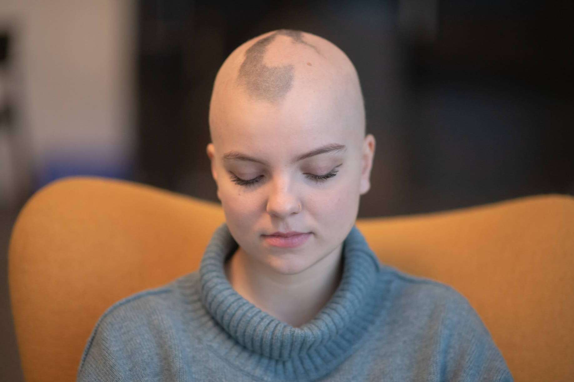 Prótesis capilares, la alternativa a la pérdida de cabello