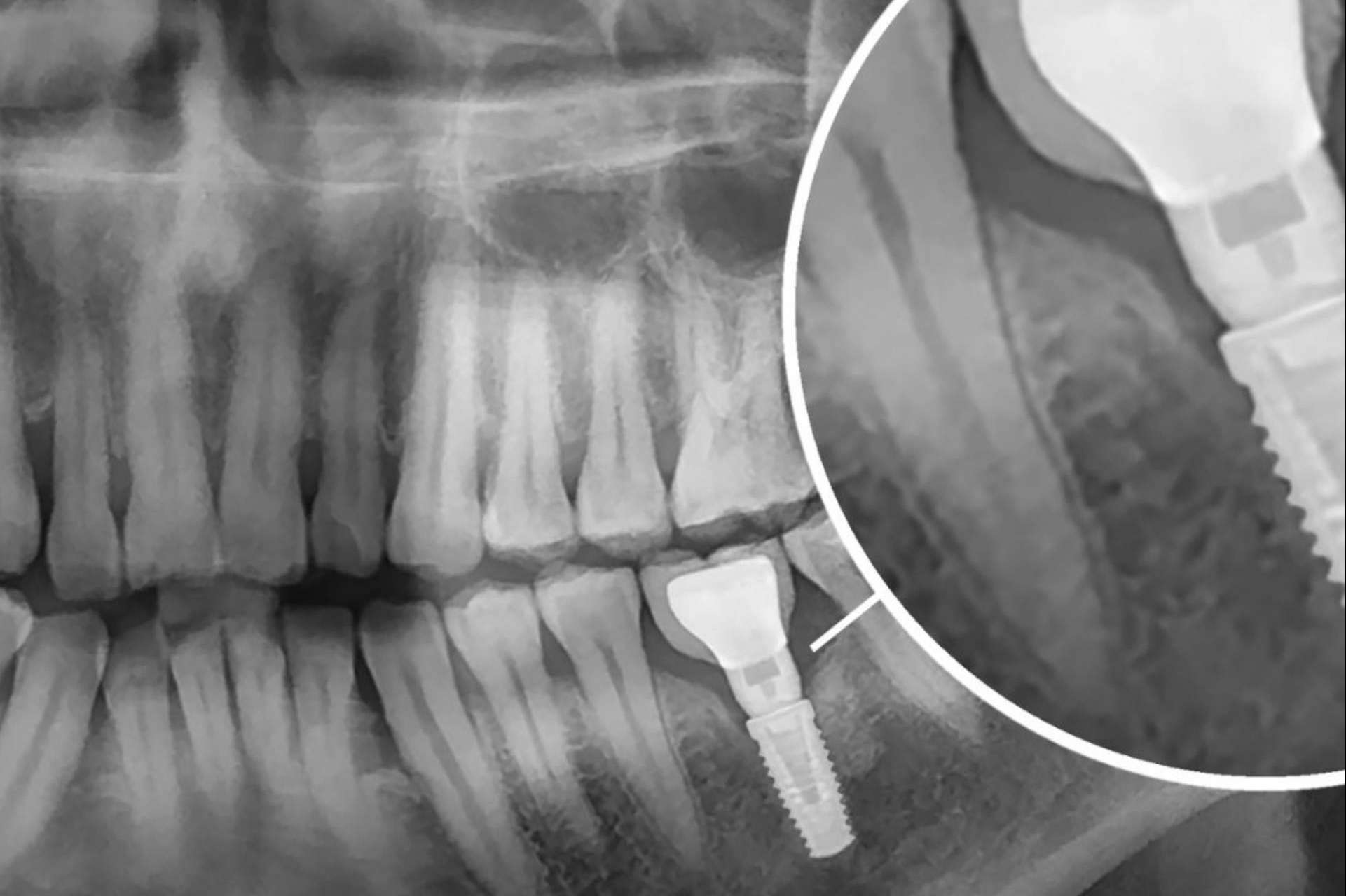 Implantes dentales en la clínica dental del Dr. Román Hernández para recuperar la funcionalidad de la boca