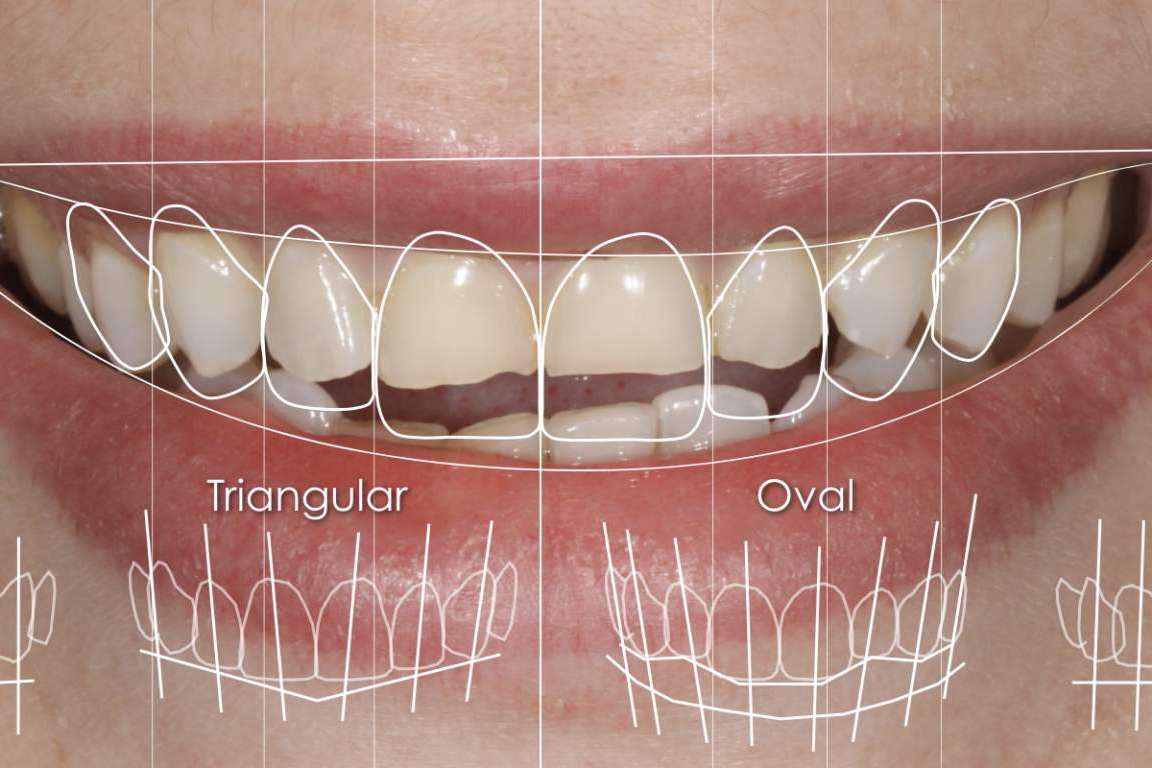 ¿Por qué realizarse un diseño de sonrisa en la Clínica Dental Ruiz de Gopegui?